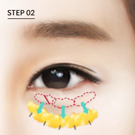 วิธีจัดเรียงไขมันใต้ตาใหม่ผ่านเยื่อบุตา (transconjunctival)
