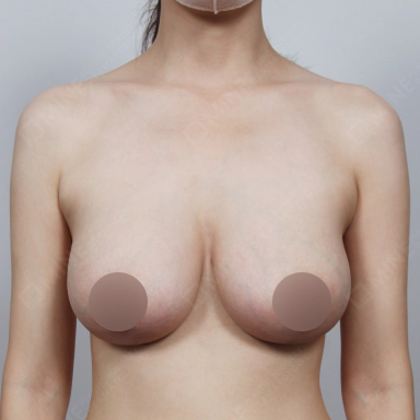 가슴성형 수술후 풍만하고 균형있는 가슴을 얻은 여성.