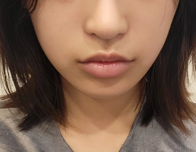 หญิงก่อนการทำฟิลเลอร์ที่ใบหน้าสูญเสียวอลลุ่ม