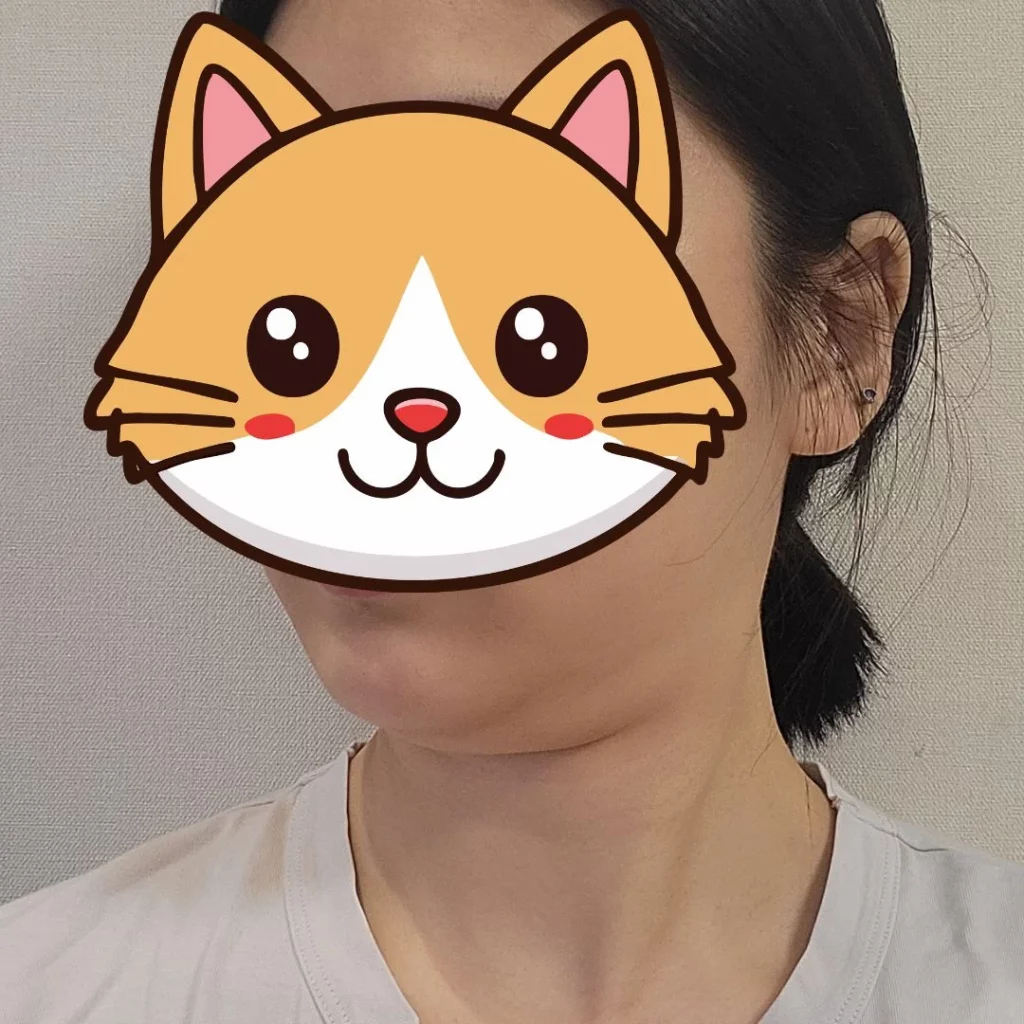 รีวิวลดเหนียง ด้านข้างหลังมัดกล้ามเนื้อใต้คาง ลดเหนียง รีวิว