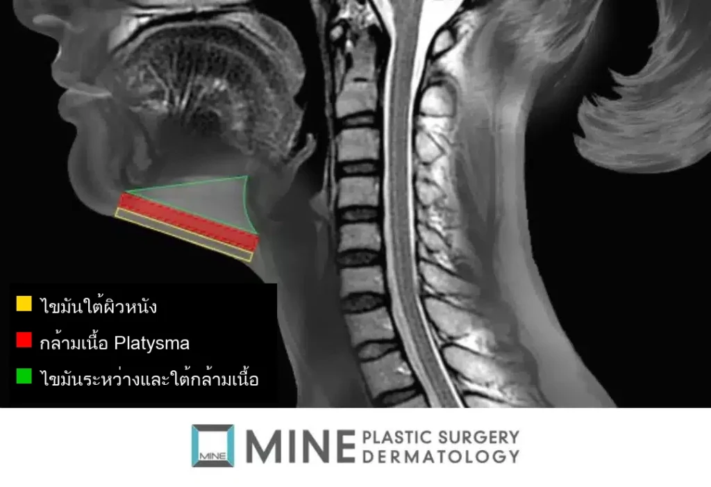 ภาพ MRI แสดงโครงสร้างใต้คาง ไขมันใต้ผิวหนัง กล้ามเนื้อ Platysma