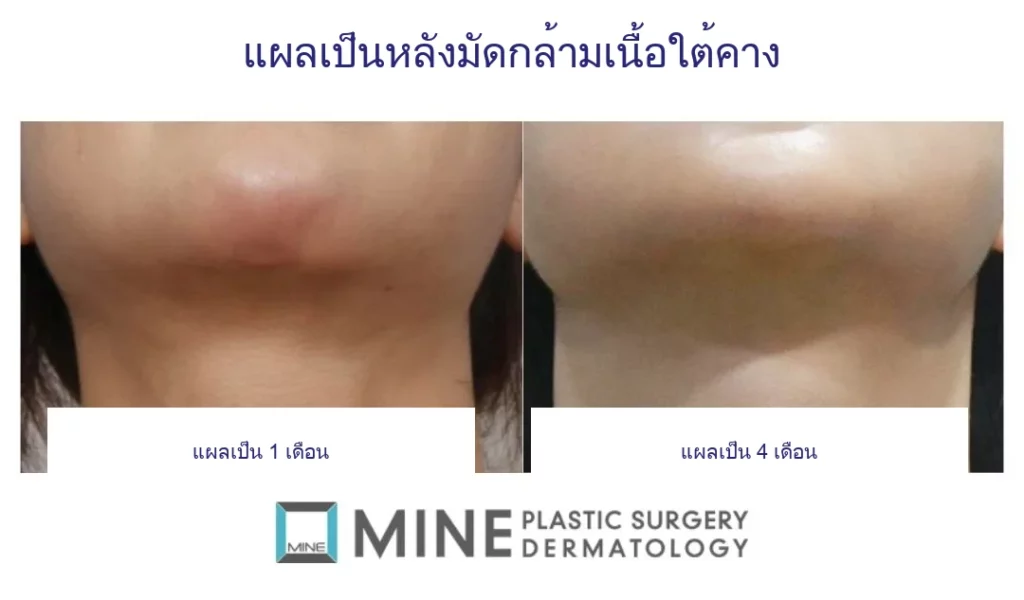 แผลเป็นหลังมัดกล้ามเนื้อใต้คาง เปรียบเทียบ 1 เดือน และ 4 เดือน