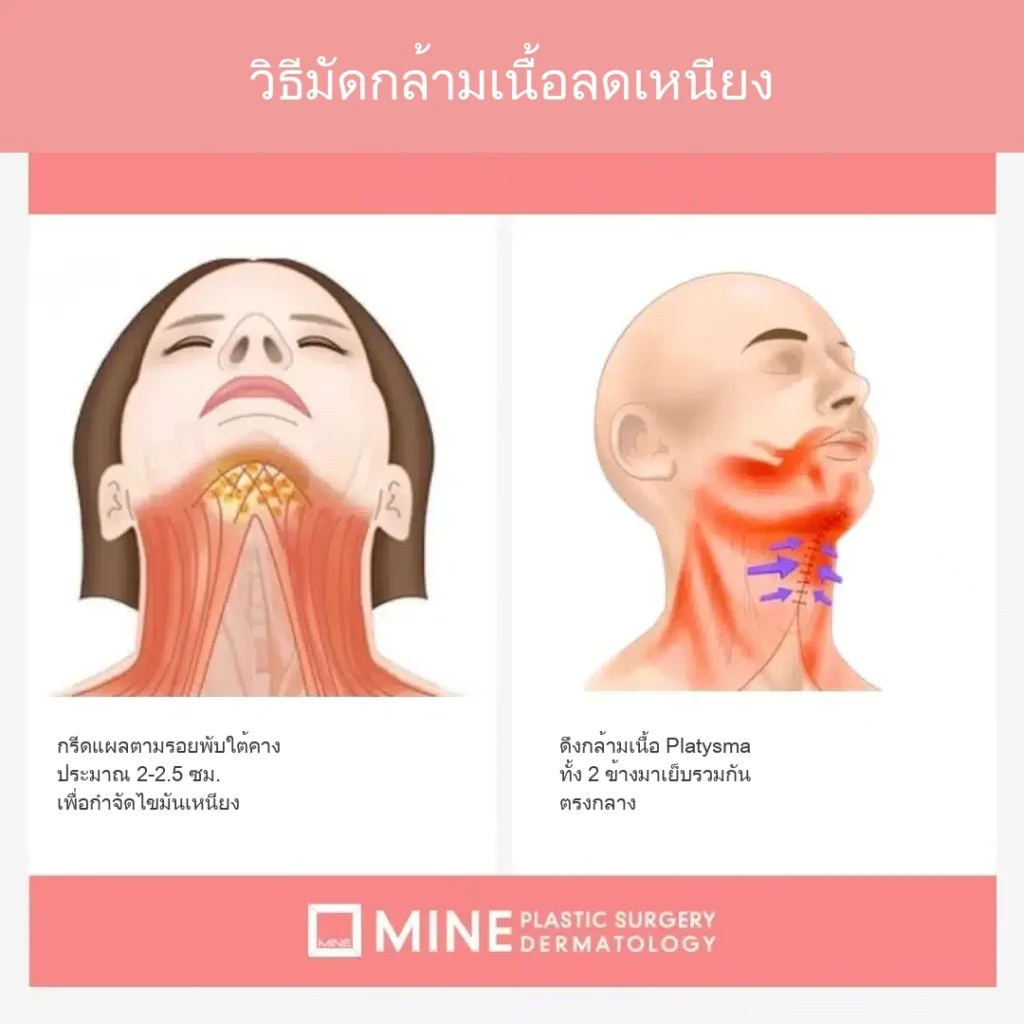 วิธีมัดกล้ามเนื้อลดเหนียง กรีดแผลตามรอยพับใต้คาง