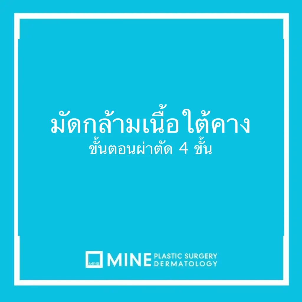 มัดกล้ามเนื้อใต้คาง ขั้นตอนผ่าตัด 4 ขั้น