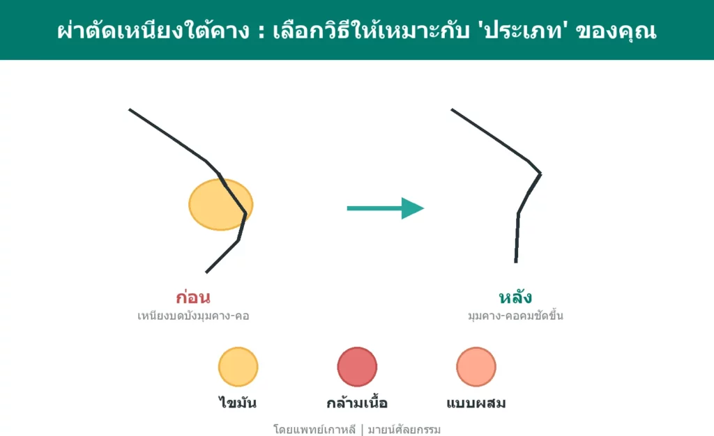 ผ่าตัดเหนียงใต้คาง: เปรียบเทียบ 3 ประเภทและวิธีที่เหมาะ