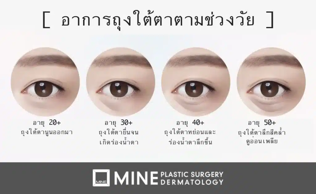 ผ่าตัดถุงใต้ตา (จัดเรียงไขมันใต้ตา): สาเหตุ วิธีผ่าตัด ฟื้นตัว และผลข้างเคียง