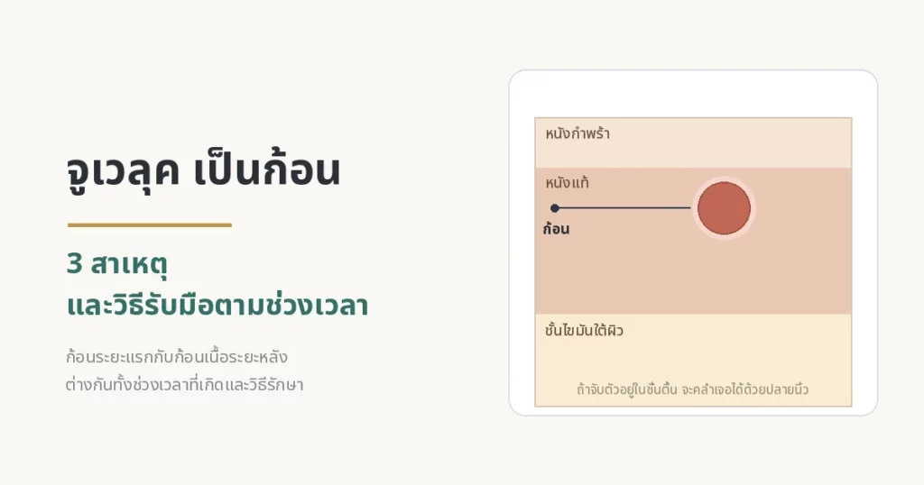 จูเวลุค เป็นก้อน — ภาพตัดขวางผิวหนังอธิบายสาเหตุและการป้องกันการเกิดก้อน