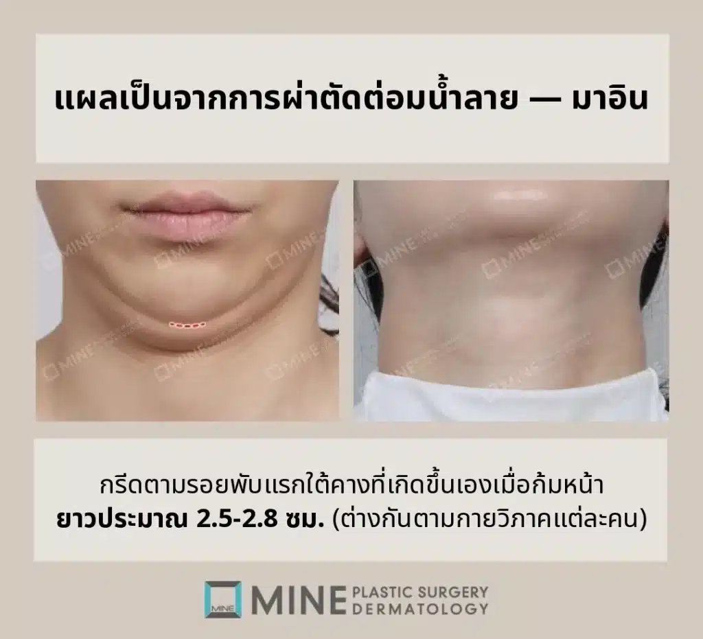 ผ่าตัดต่อมน้ำลาย แผลเป็น — ตำแหน่งเส้นกรีดตามรอยพับแรกใต้คาง