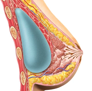 breast-hd-dual-plane-method