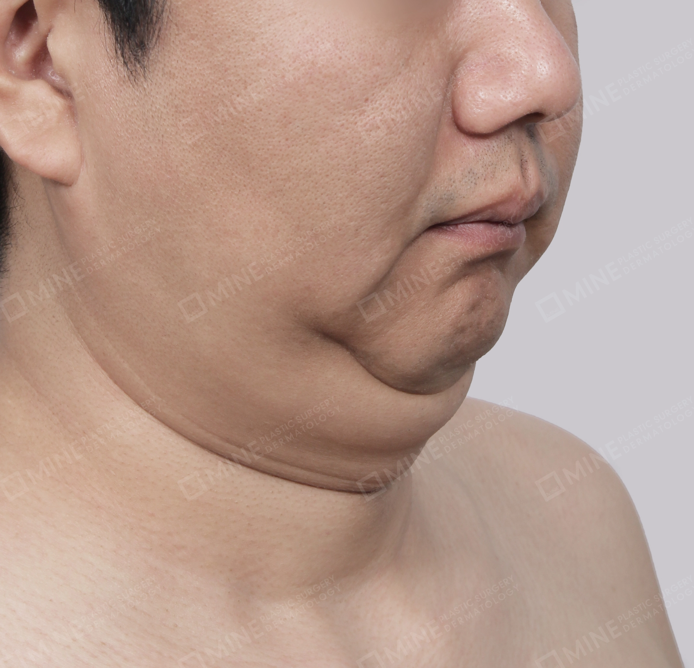 มินิลิฟติ้งคอ-ด้านหน้า-ก่อน