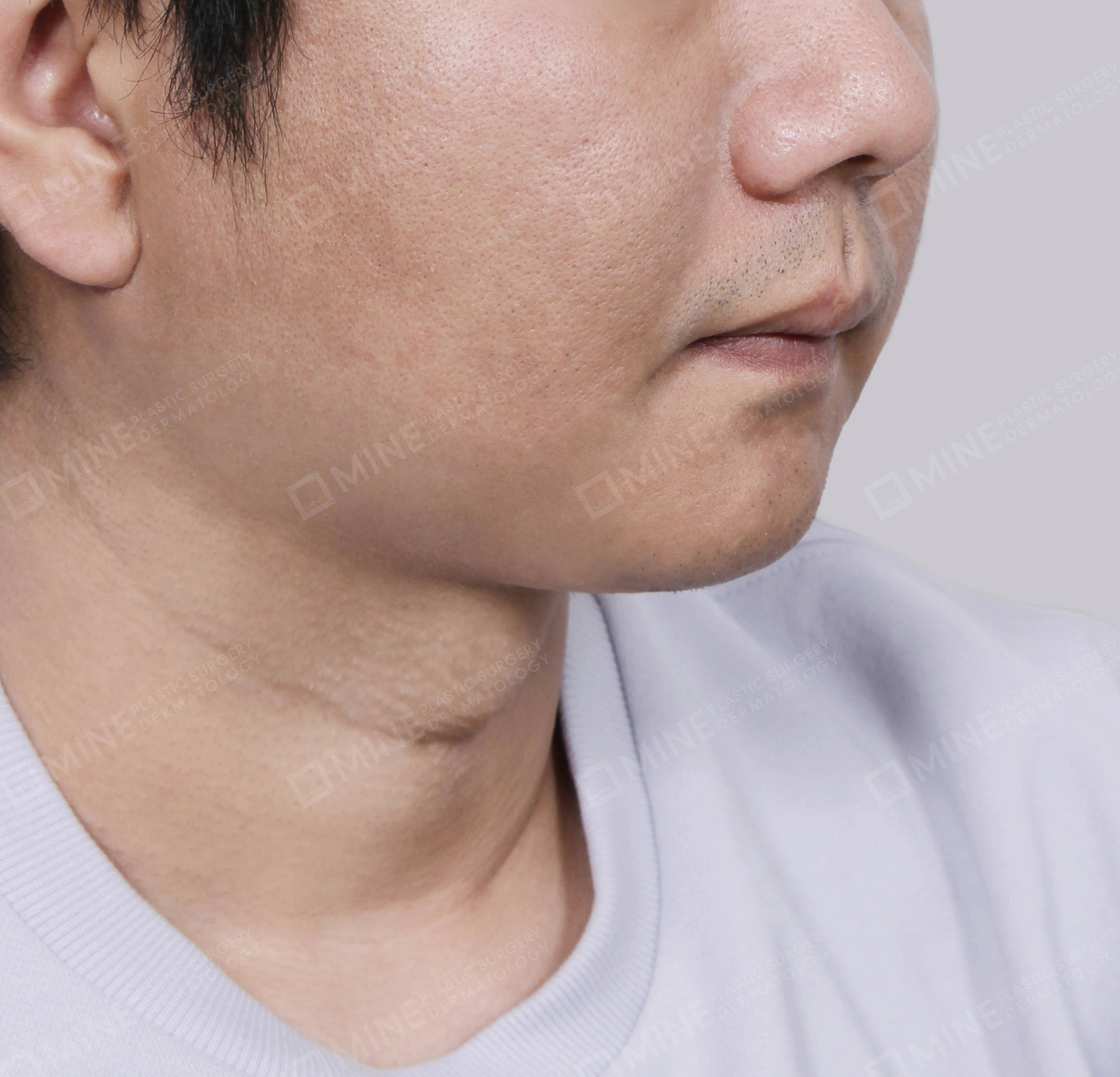 มินิลิฟติ้งคอ-ด้านหน้า-หลัง