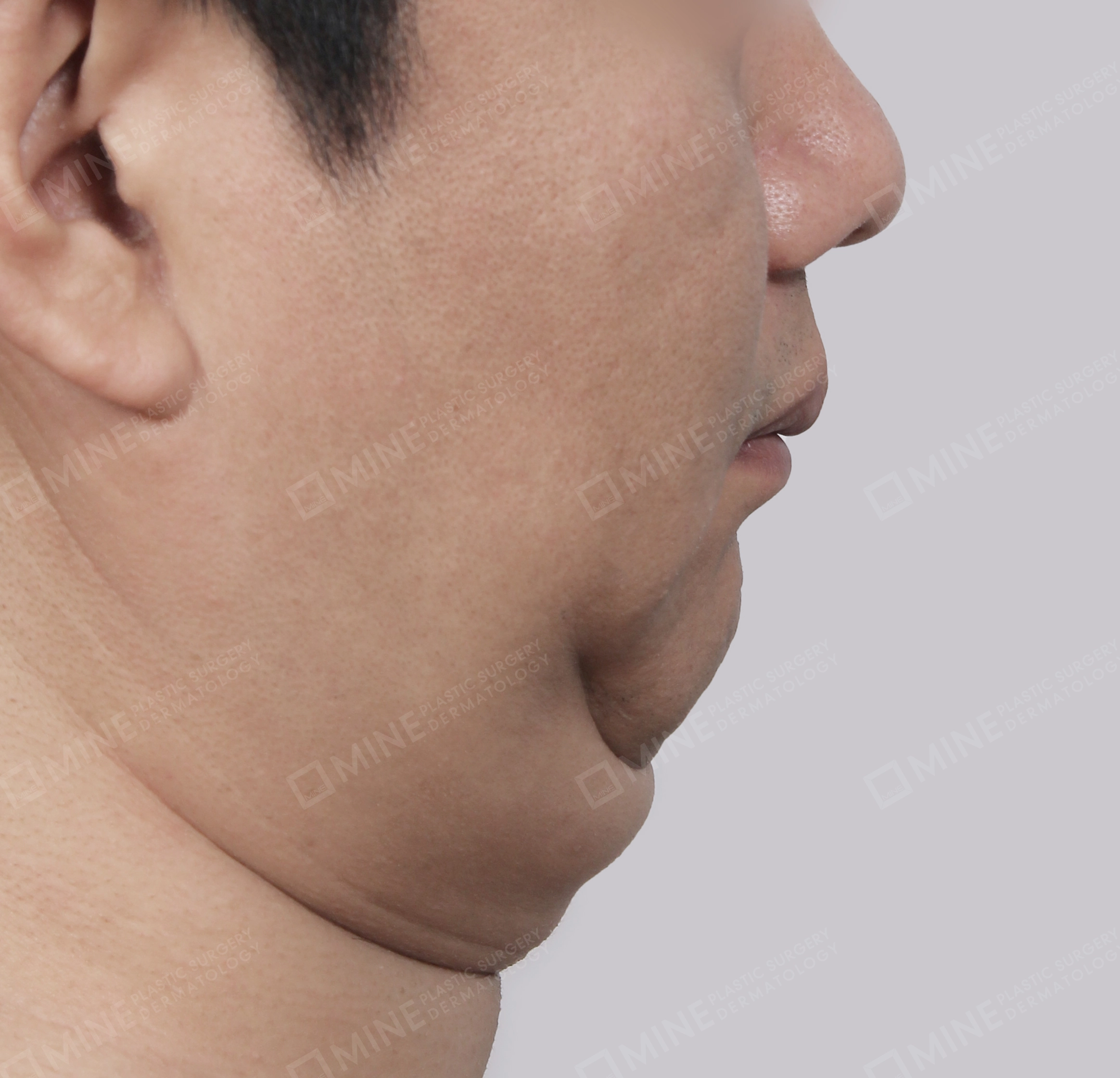 มินิลิฟติ้งคอ-ด้านข้าง-ก่อน