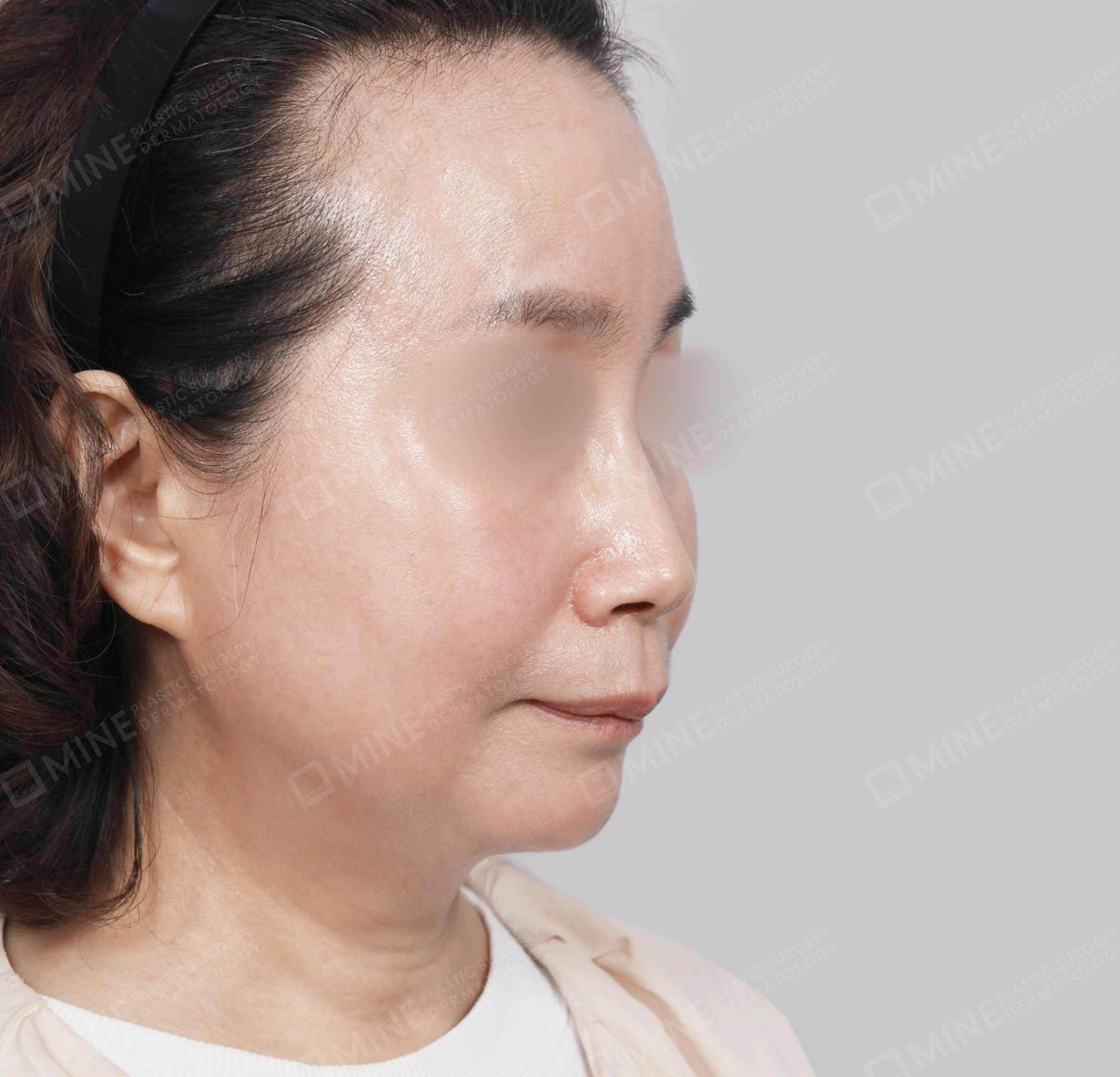 ยกกระชับหน้า-45 องศา-หลัง