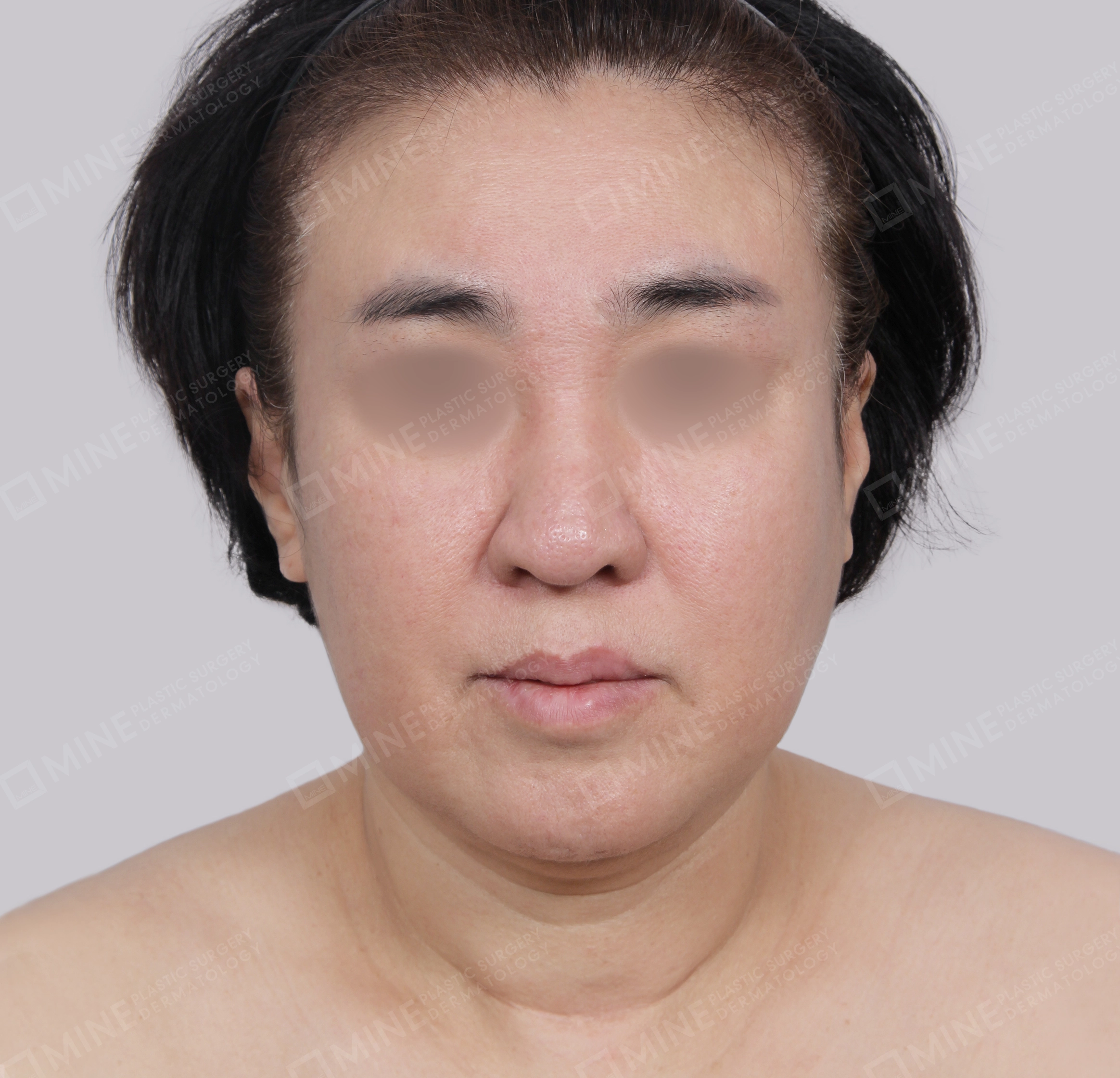 ยกกระชับหน้า-ด้านหน้า-ก่อน