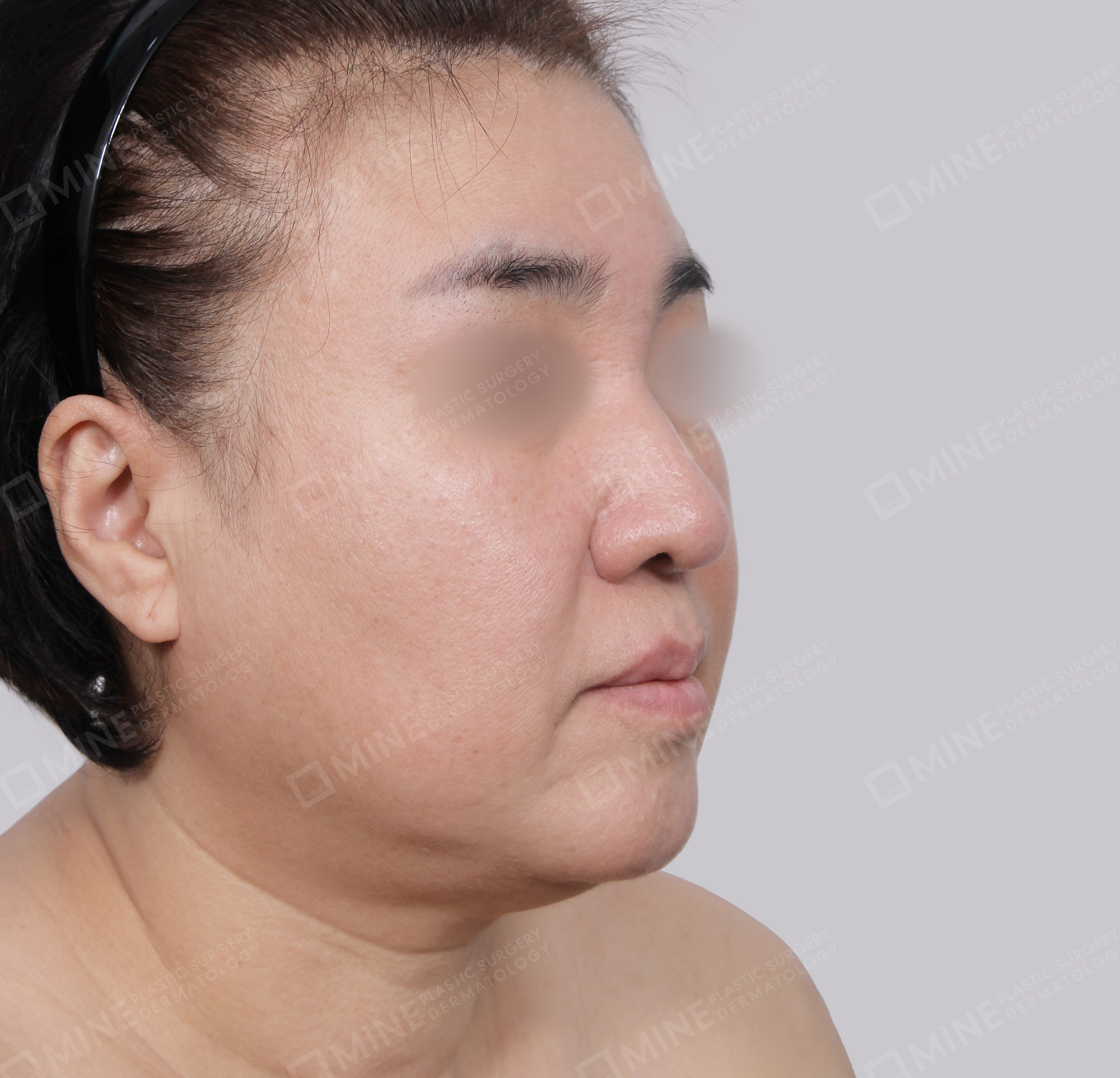ยกกระชับหน้า-45 องศา-ก่อน