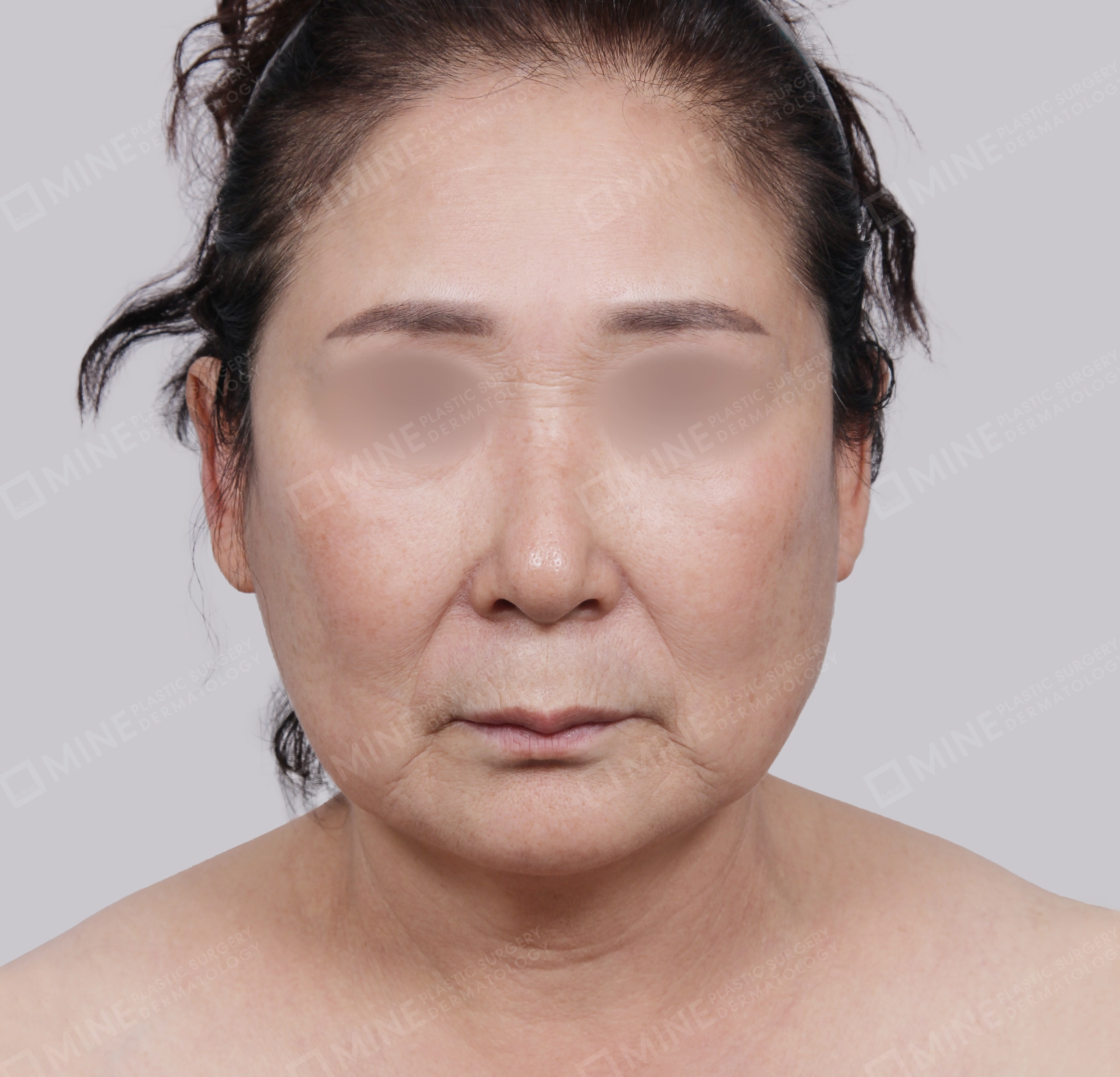 ยกกระชับหน้า-ด้านหน้า-ก่อน