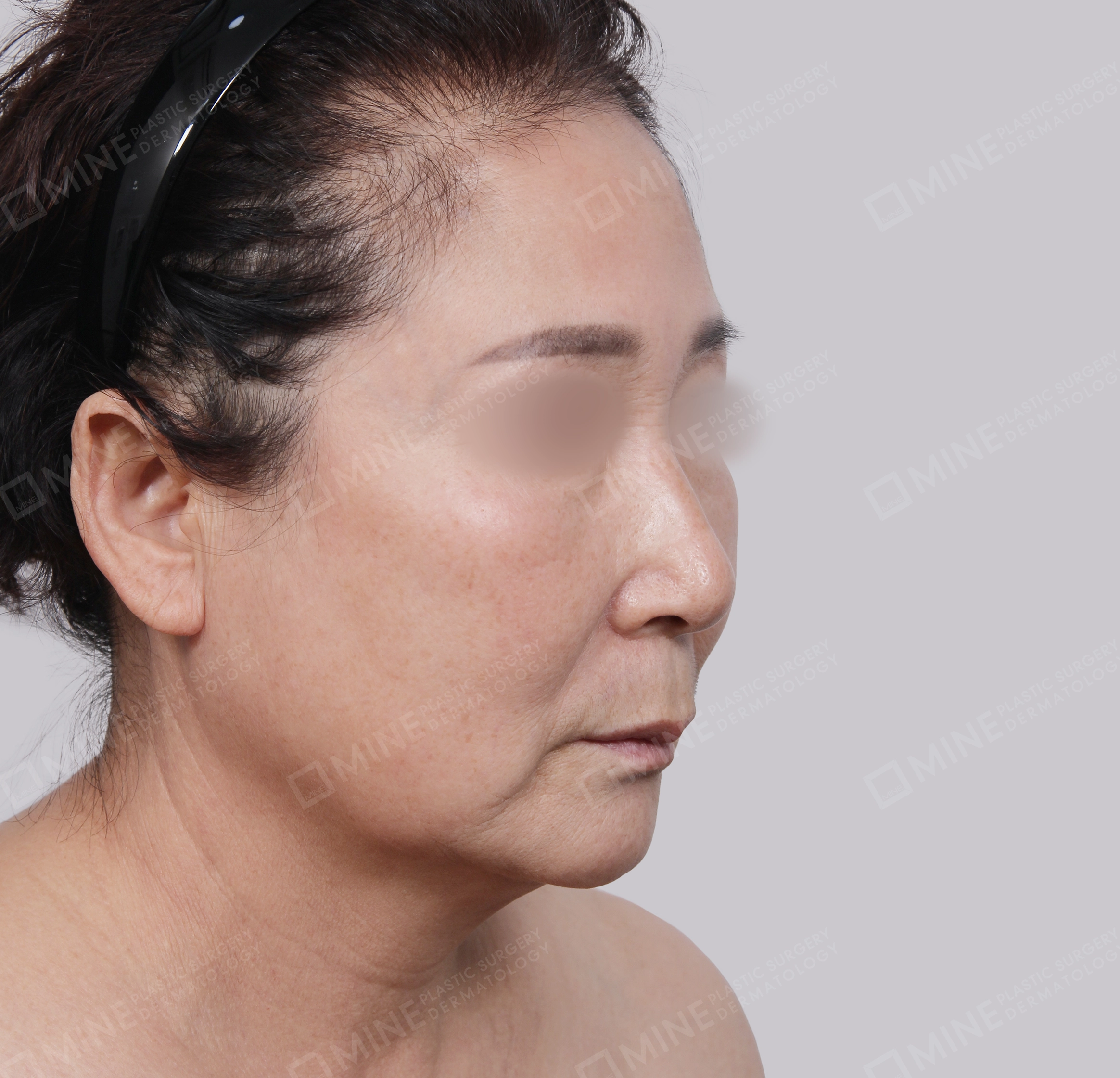 ยกกระชับหน้า-45 องศา-ก่อน