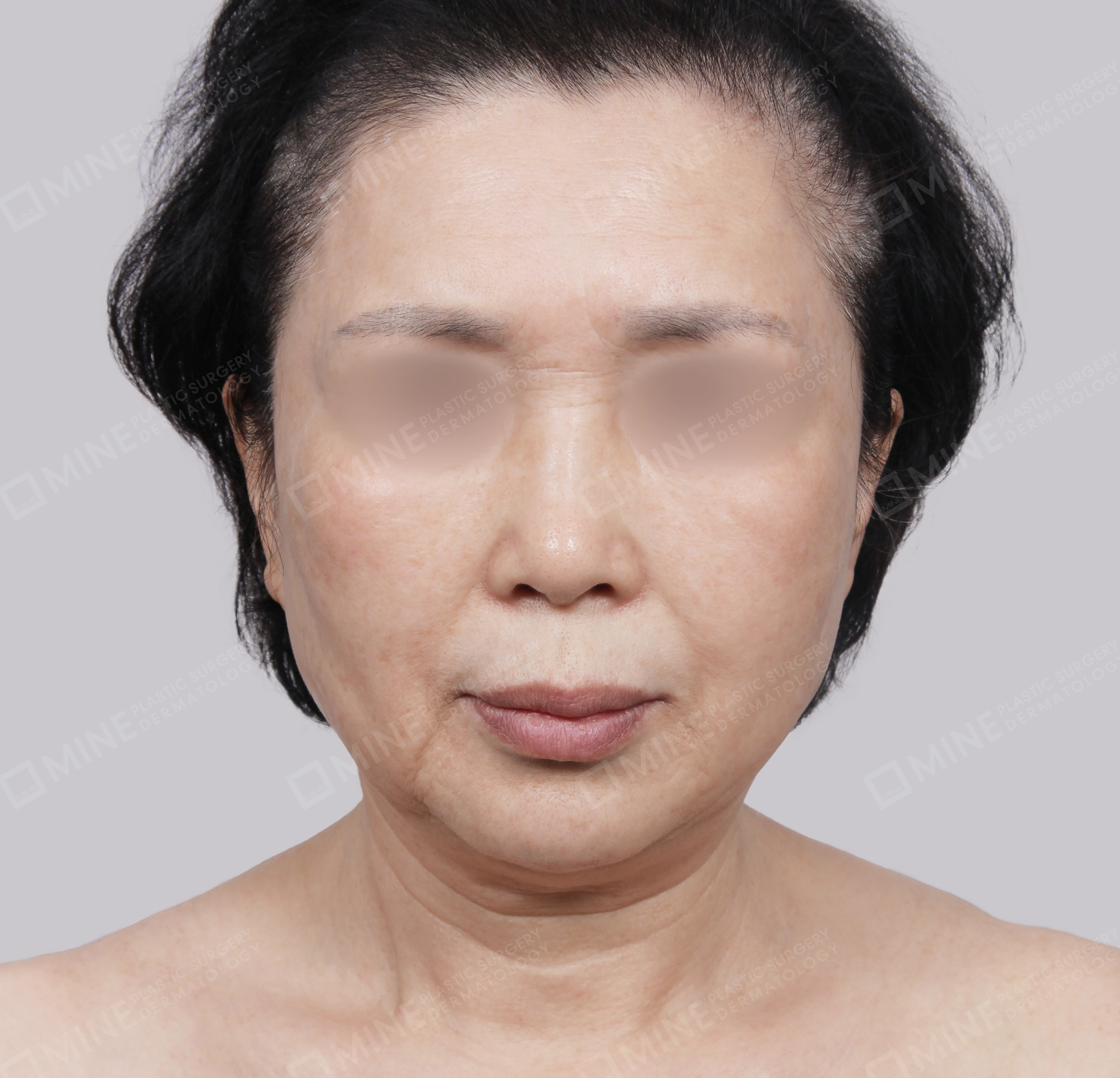 ยกกระชับหน้า-ด้านหน้า-ก่อน