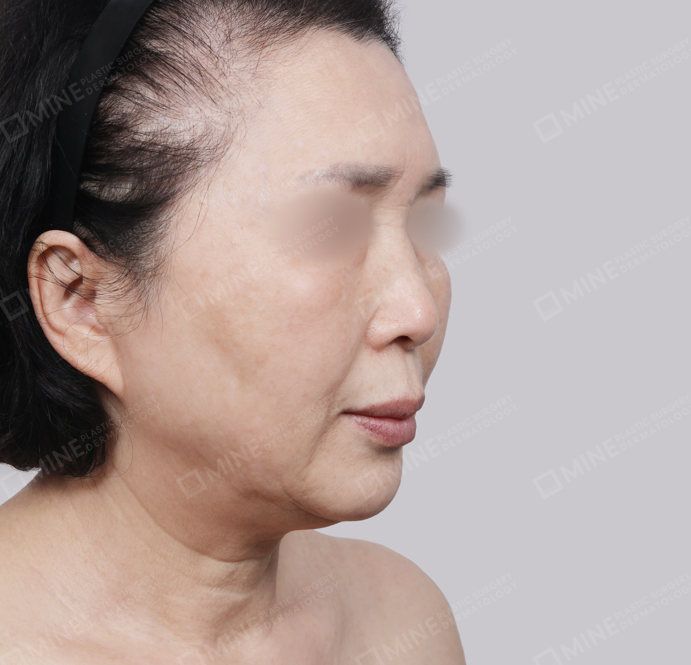 ยกกระชับหน้า-45 องศา-ก่อน