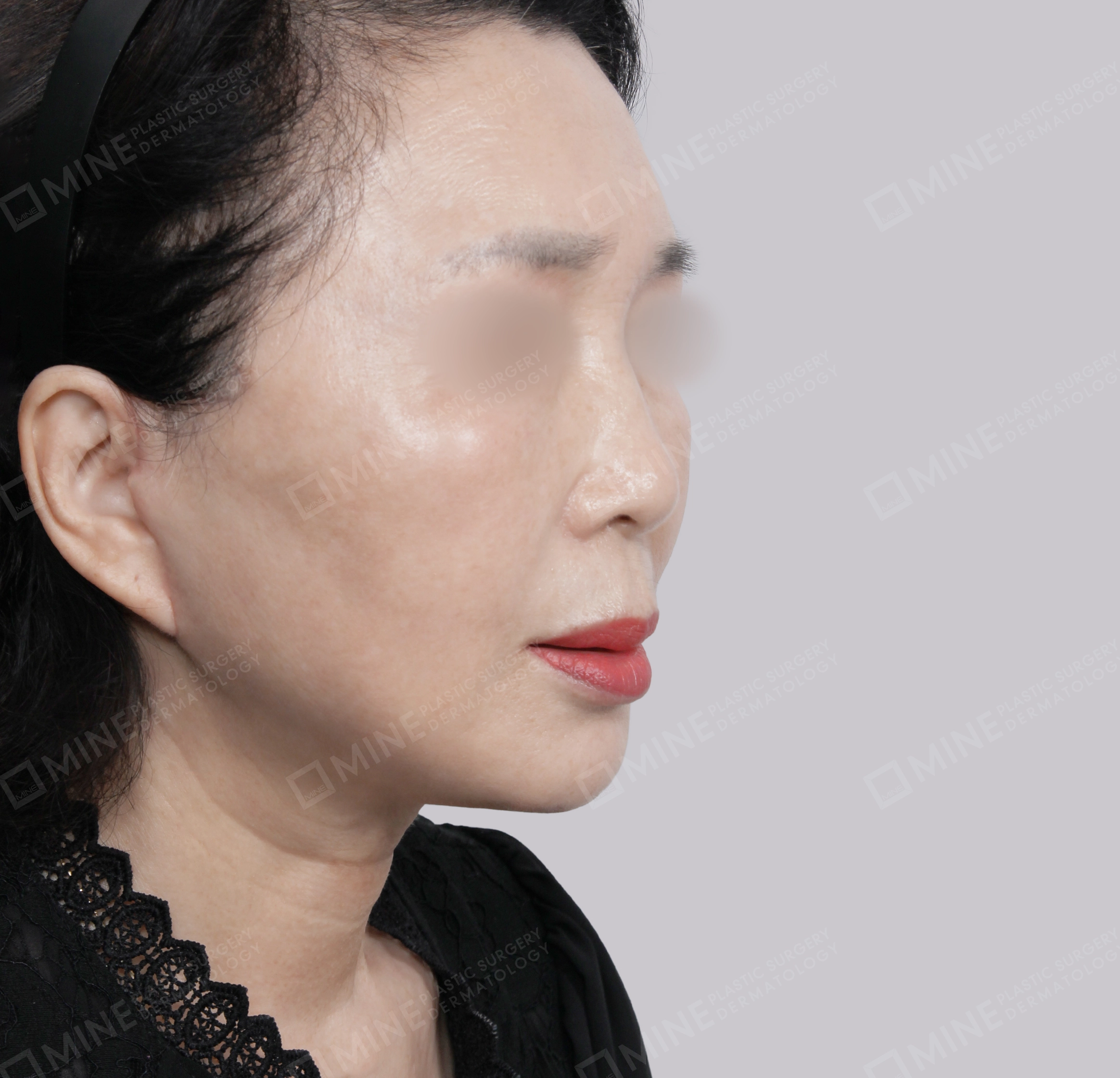 ยกกระชับหน้า-45 องศา-หลัง