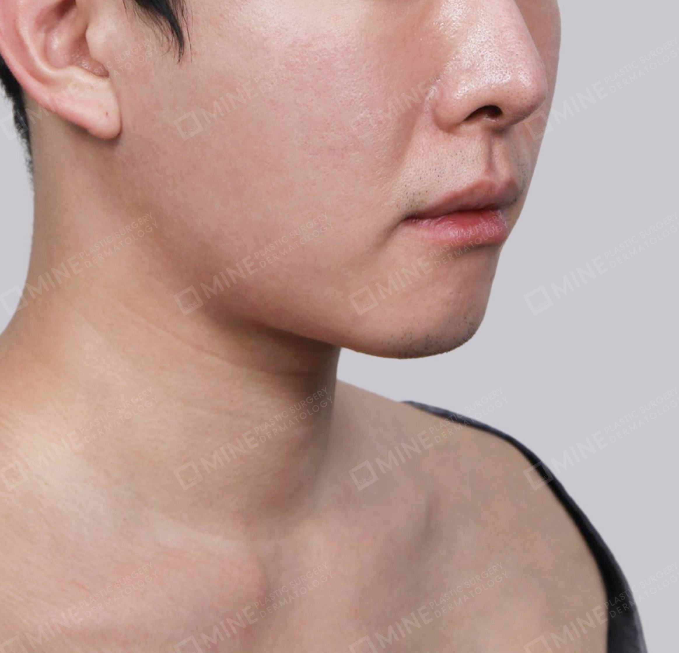 มัดกล้ามเนื้อคาง-ด้านหน้า-ก่อน
