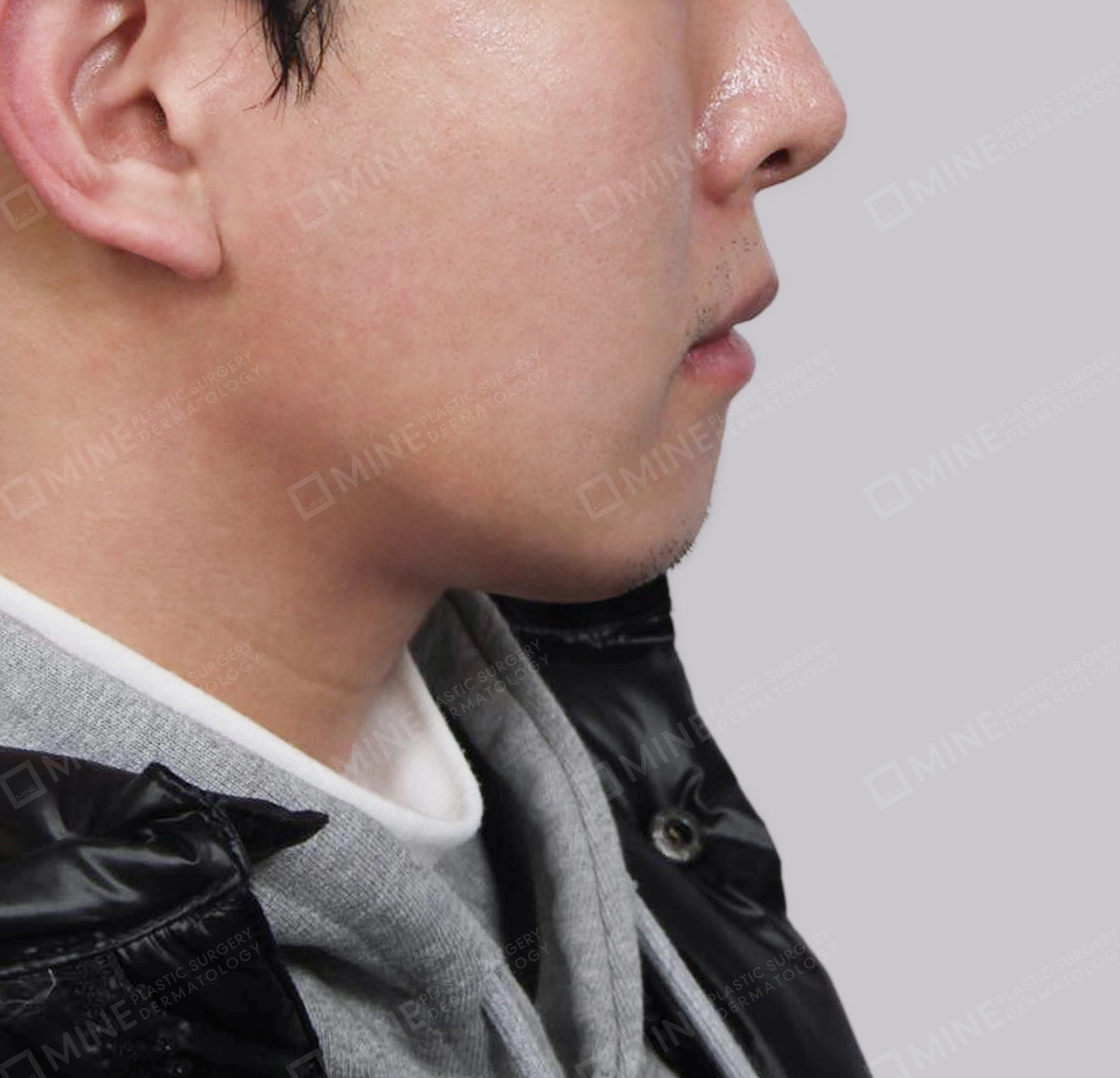 มัดกล้ามเนื้อคาง-ด้านข้าง-หลัง