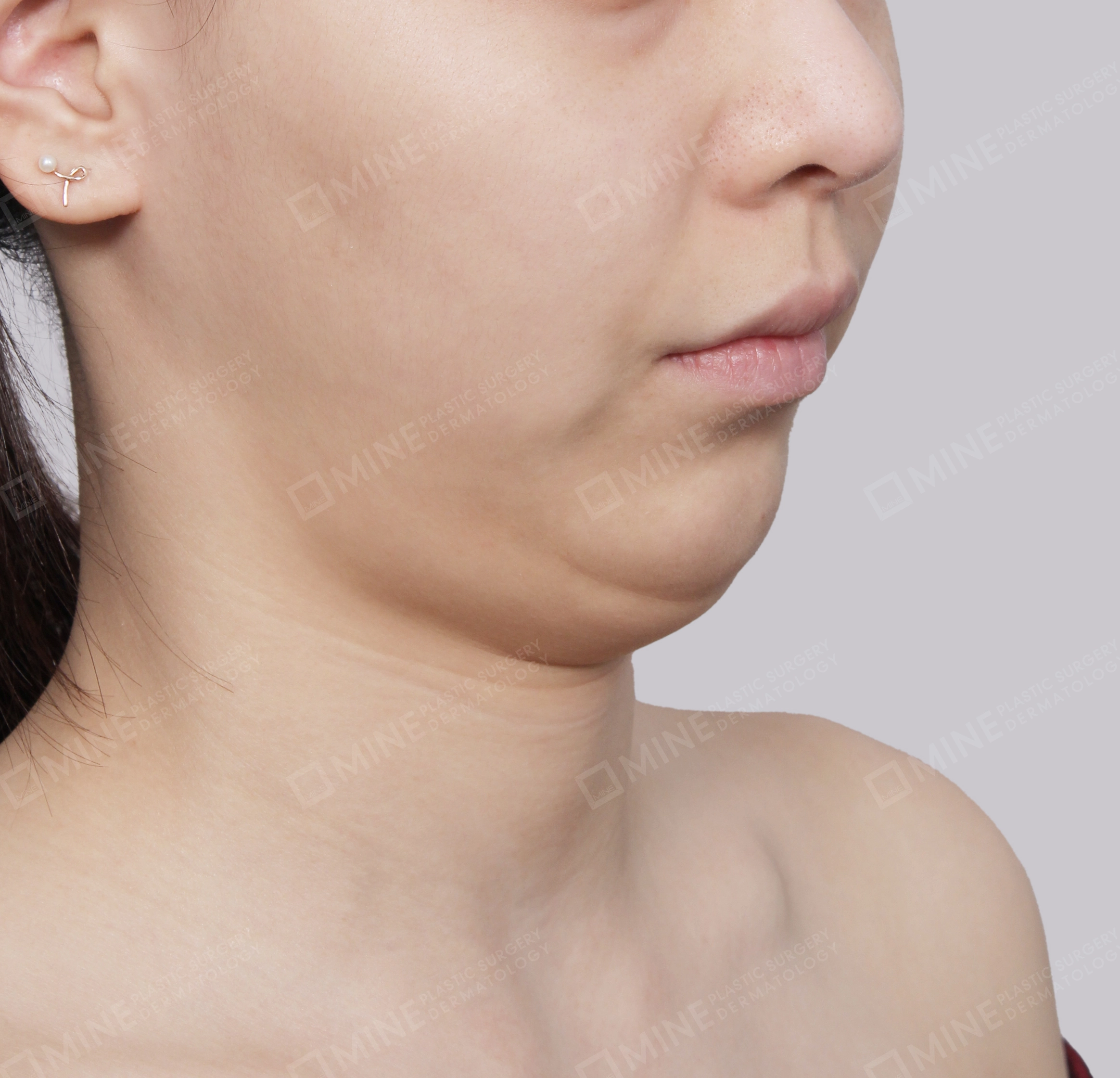 มัดกล้ามเนื้อคาง-45 องศา-ก่อน