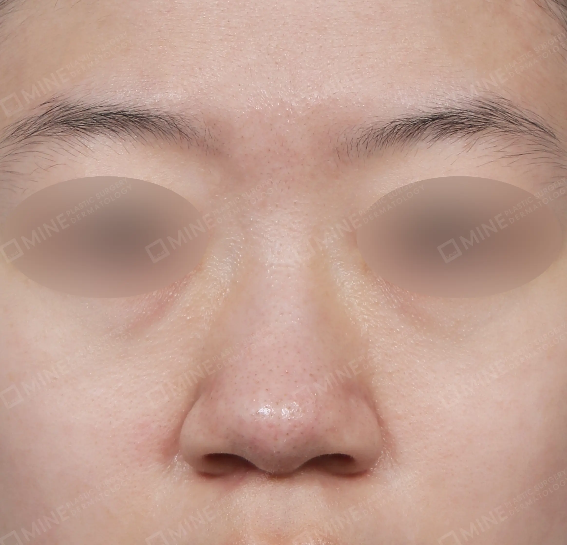 สันจมูก + ลด ปลายจมูก + ลดปีกจมูก-ด้านหน้า-ก่อน
