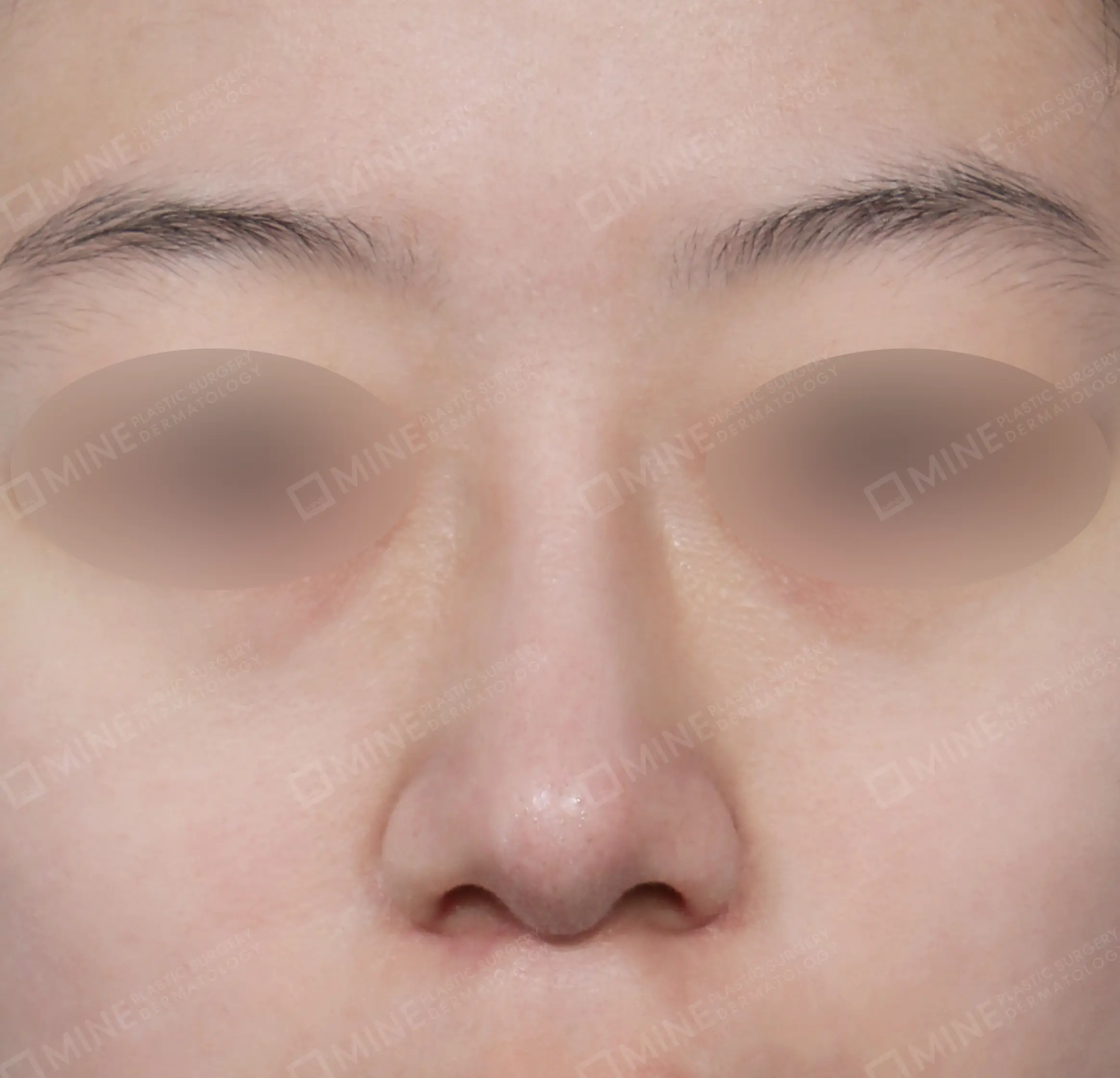 สันจมูก + ลด ปลายจมูก + ลดปีกจมูก-ด้านหน้า-หลัง