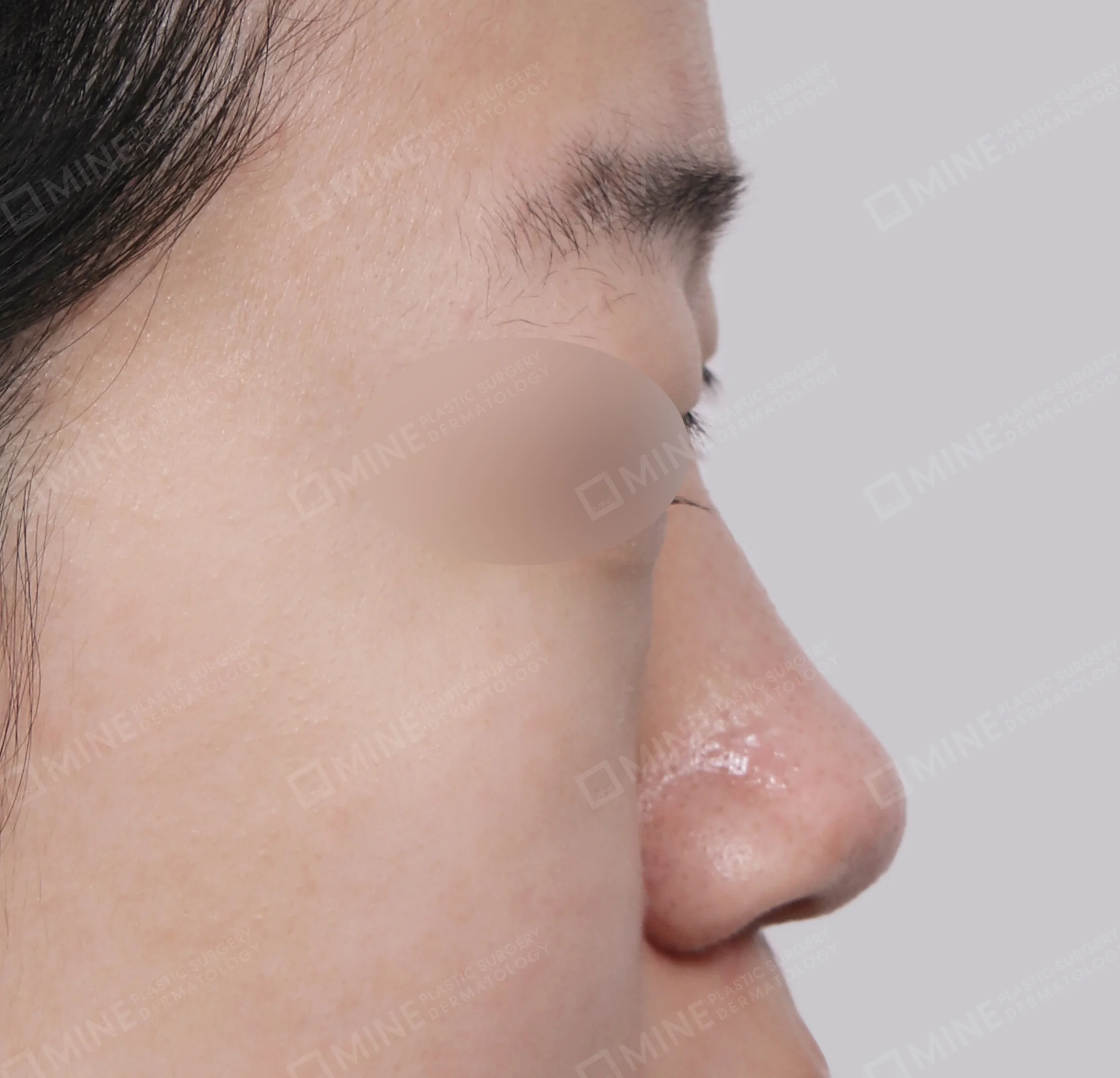 สันจมูก + ลด ปลายจมูก + ลดปีกจมูก-ด้านข้าง-ก่อน