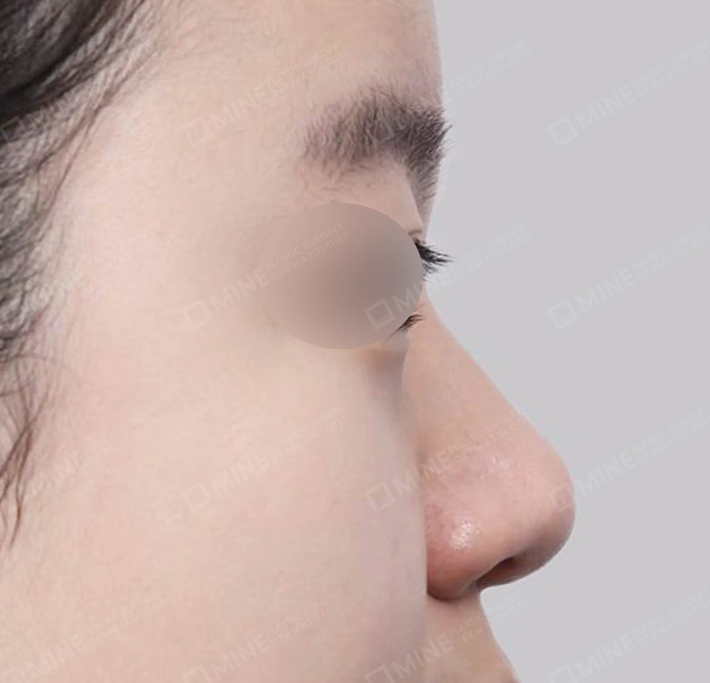 ฮัมพ์จมูก + การผ่าตัดกระดูก + ลดปีกจมูก + สันจมูก-ด้านข้าง-ก่อน