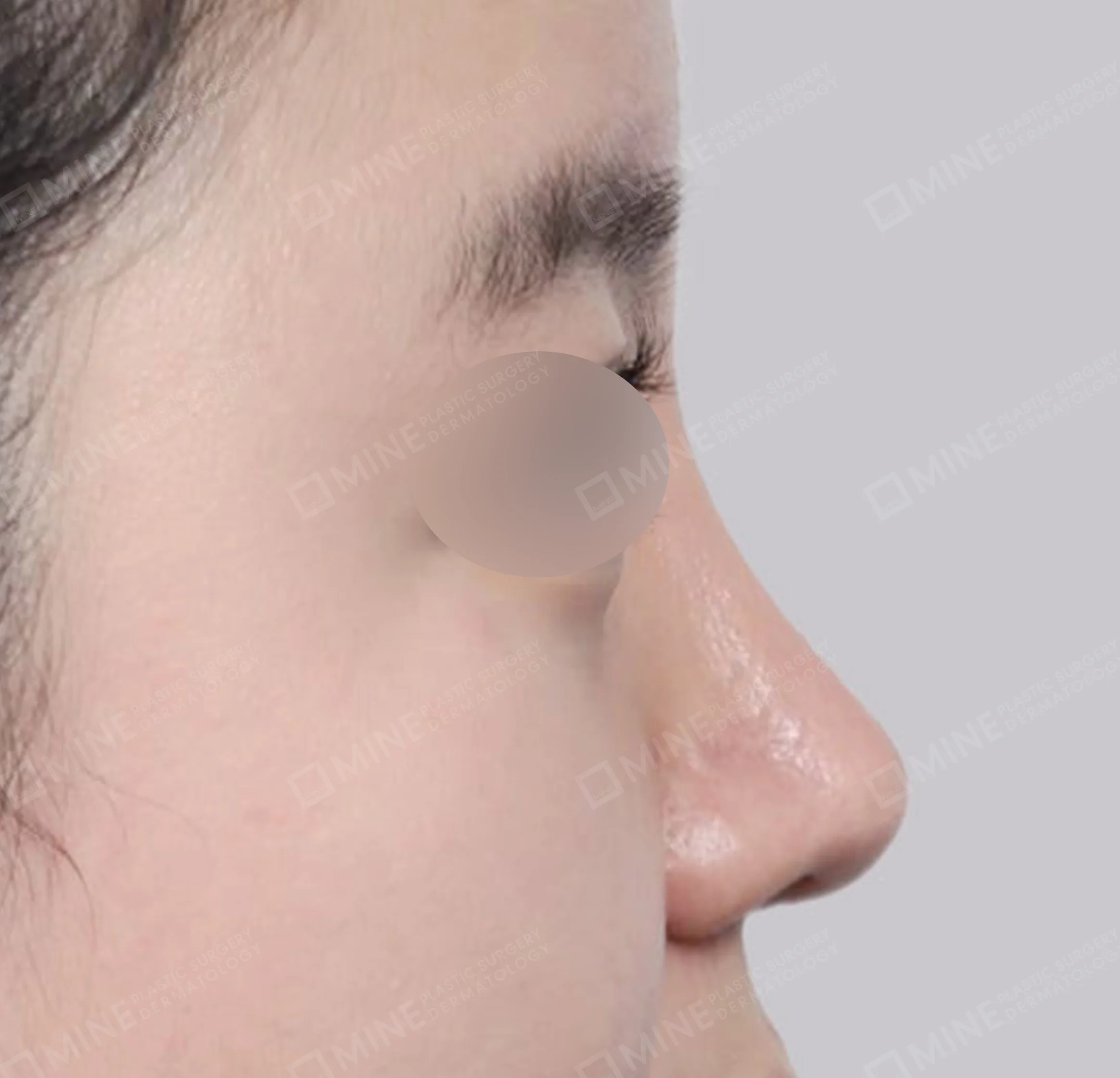 ฮัมพ์จมูก + การผ่าตัดกระดูก + ลดปีกจมูก + สันจมูก-ด้านข้าง-หลัง