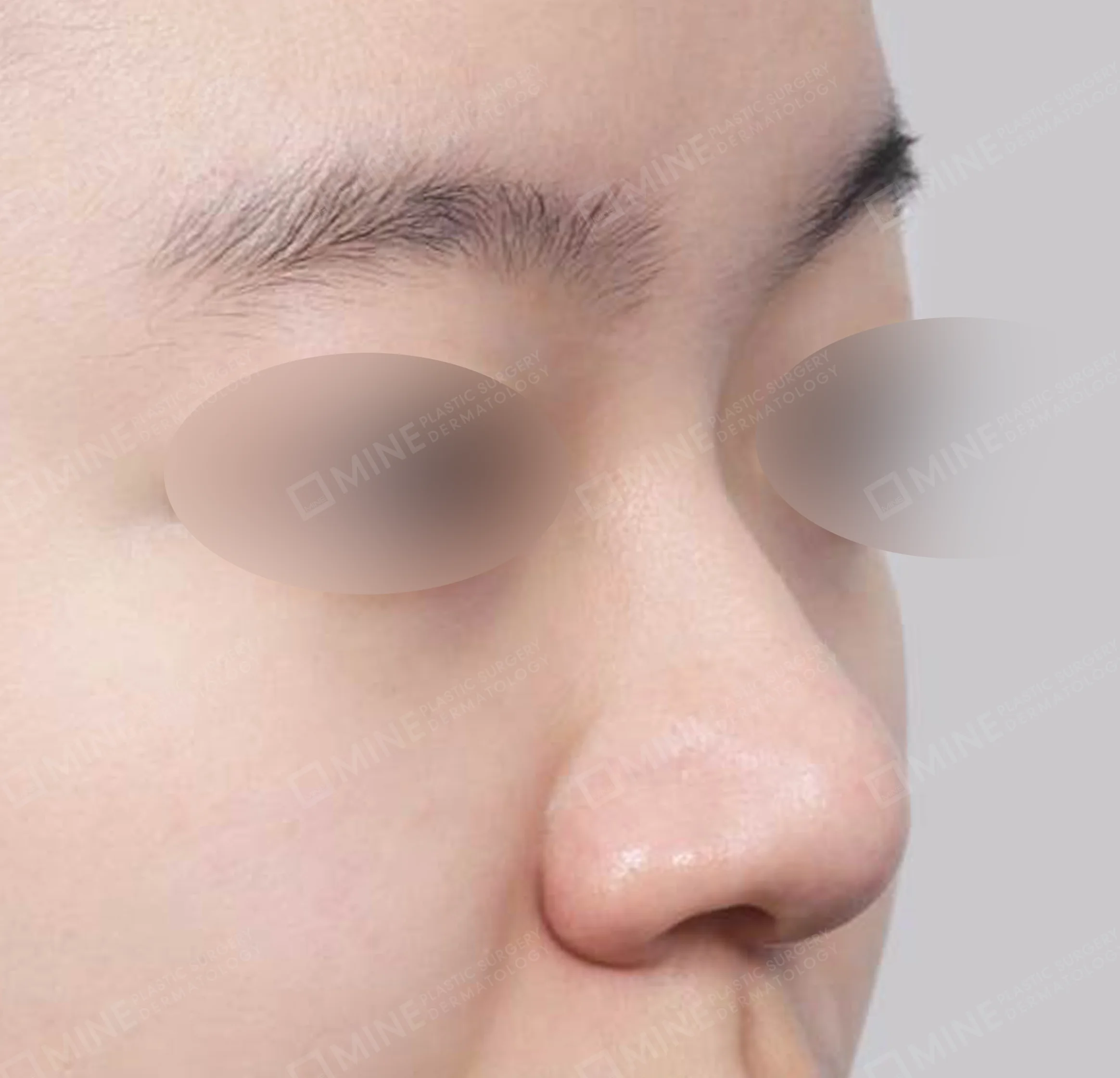 ฮัมพ์จมูก + การผ่าตัดกระดูก + ลดปีกจมูก + สันจมูก-45 องศา-ก่อน