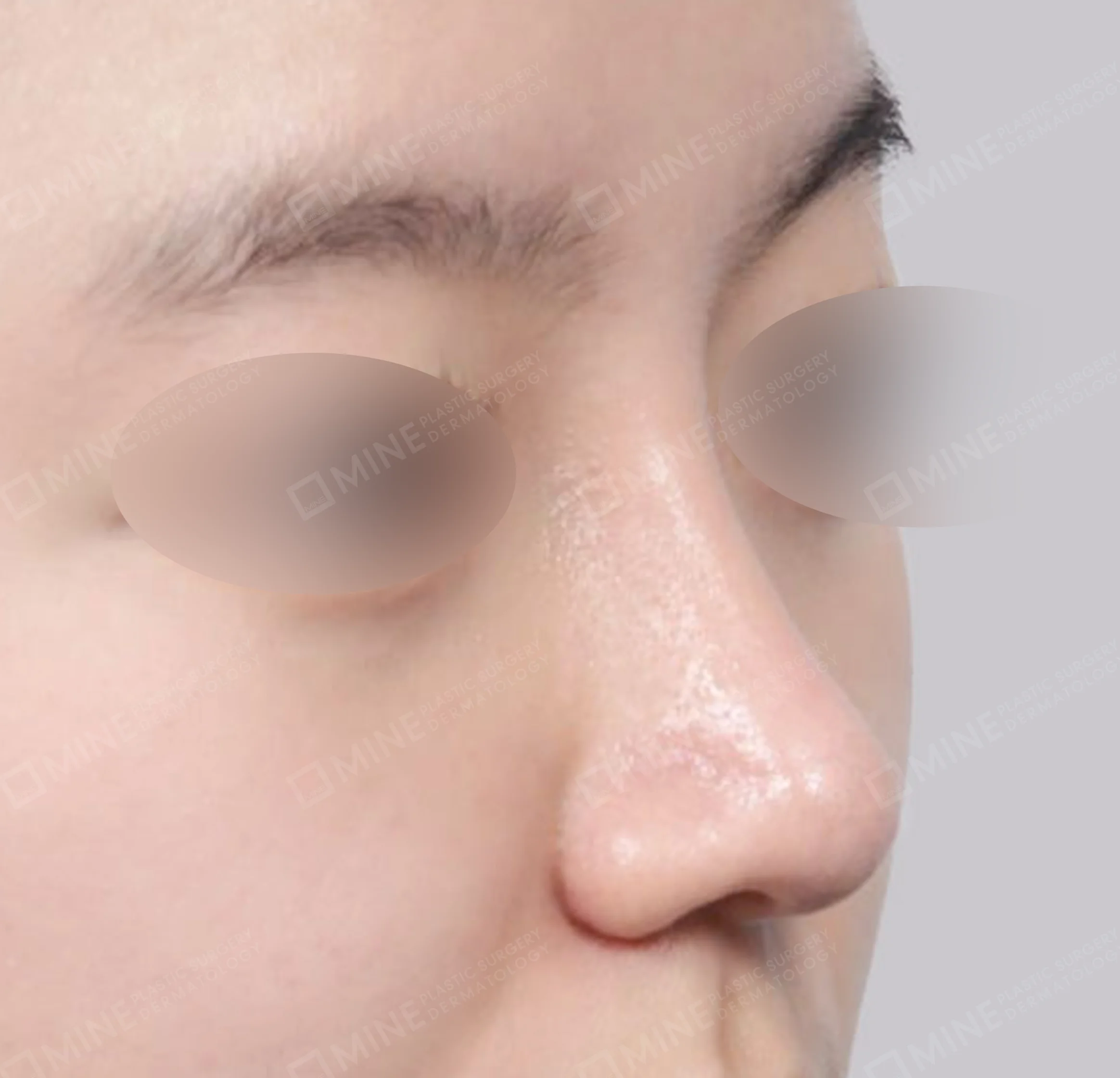 ฮัมพ์จมูก + การผ่าตัดกระดูก + ลดปีกจมูก + สันจมูก-45 องศา-หลัง