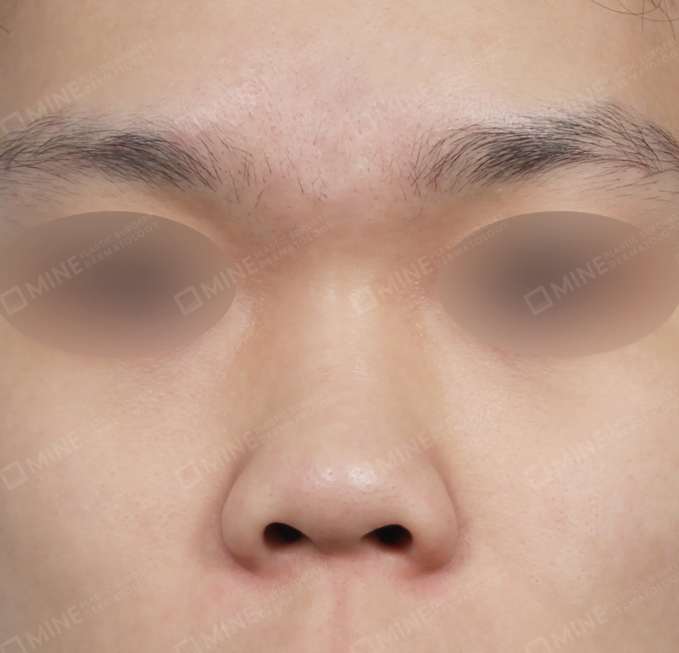 ฮัมพ์จมูก + สันจมูก + ยาวขึ้น ผนังกั้นช่องจมูก + ลด ปลายจมูก-ด้านหน้า-ก่อน