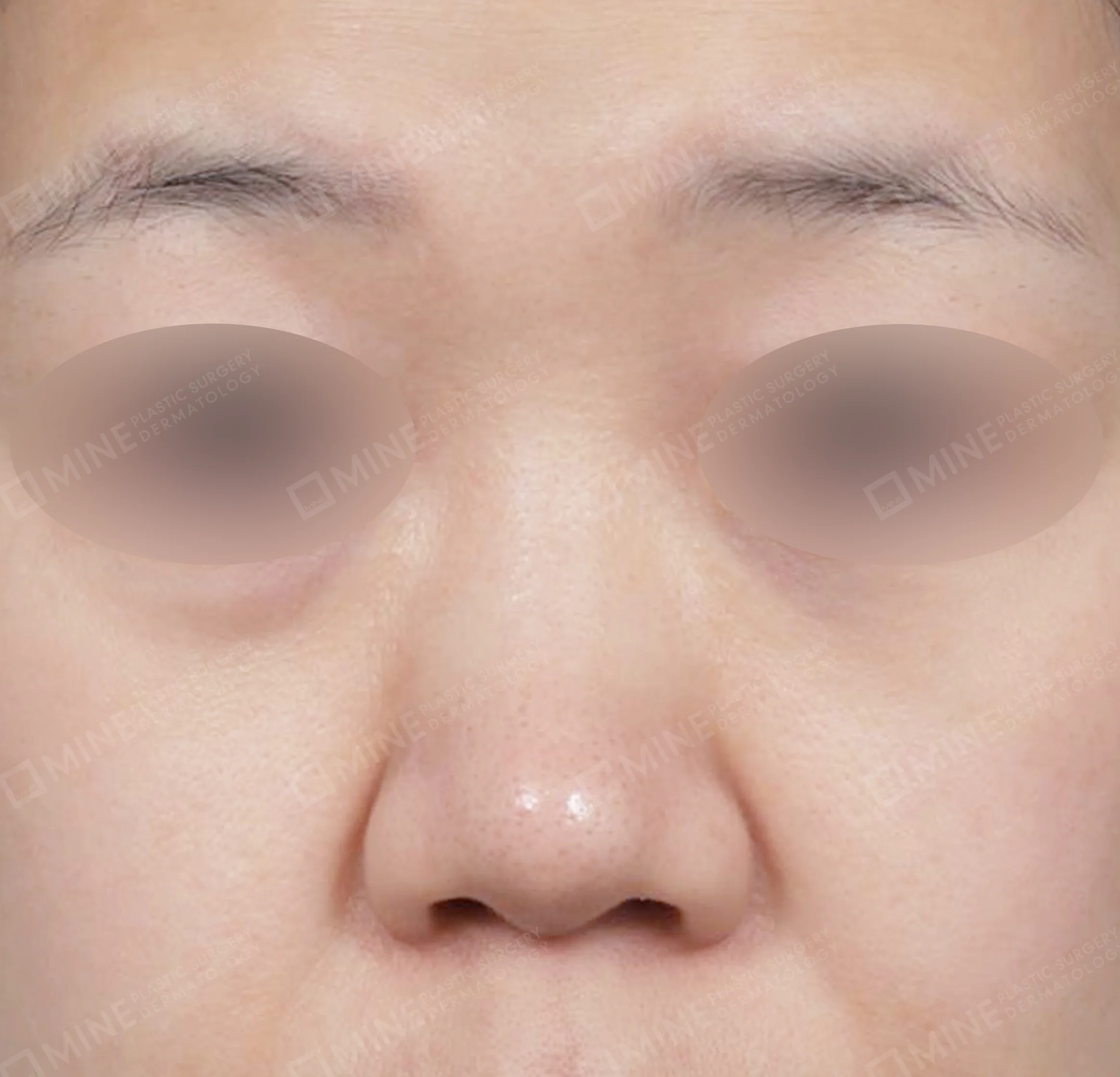 สันจมูก+ลด ปลายจมูก + ลดปีกจมูก + ยาวขึ้น ผนังกั้นช่องจมูก-ด้านหน้า-ก่อน