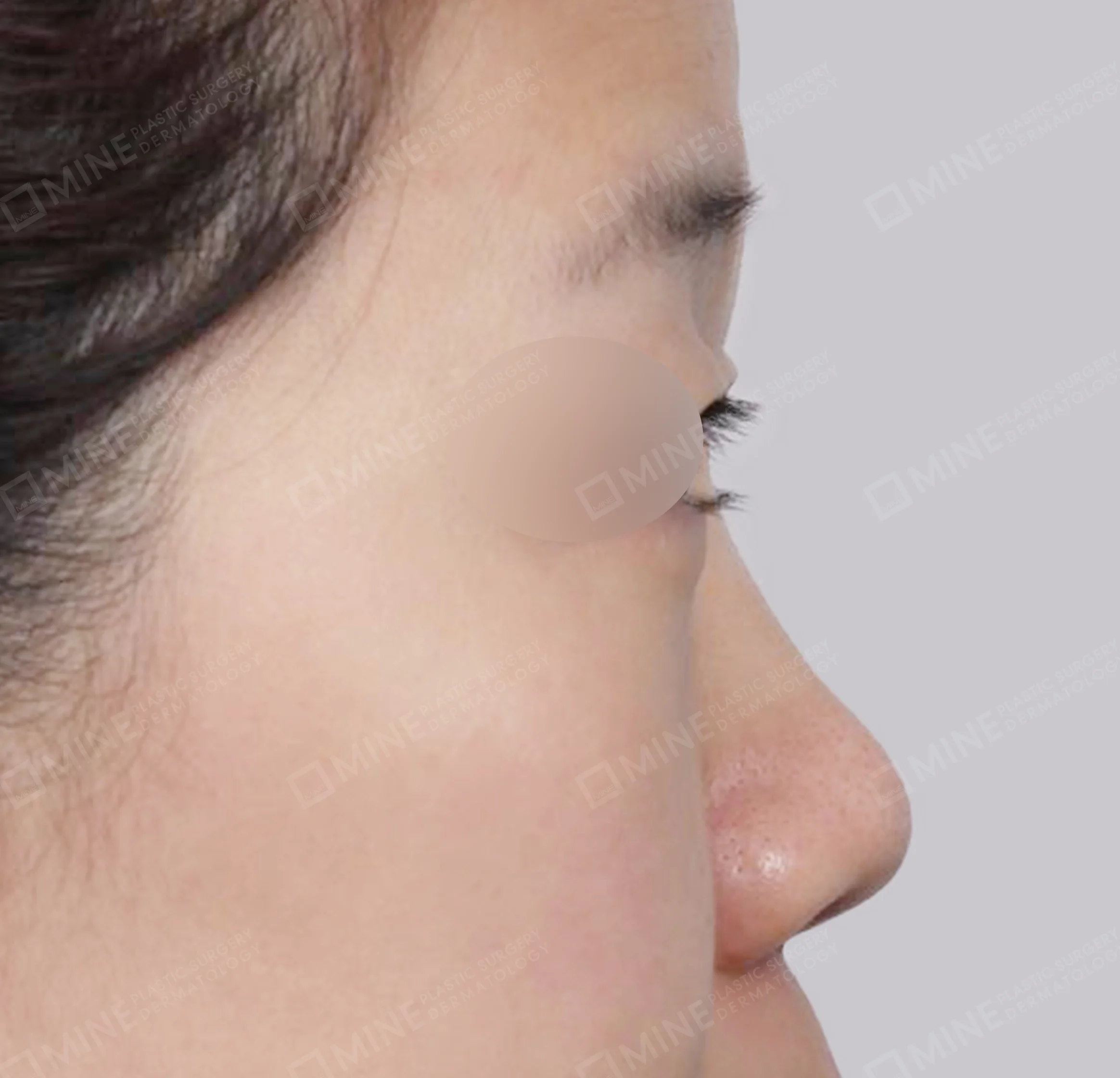 สันจมูก+ลด ปลายจมูก + ลดปีกจมูก + ยาวขึ้น ผนังกั้นช่องจมูก-ด้านข้าง-ก่อน