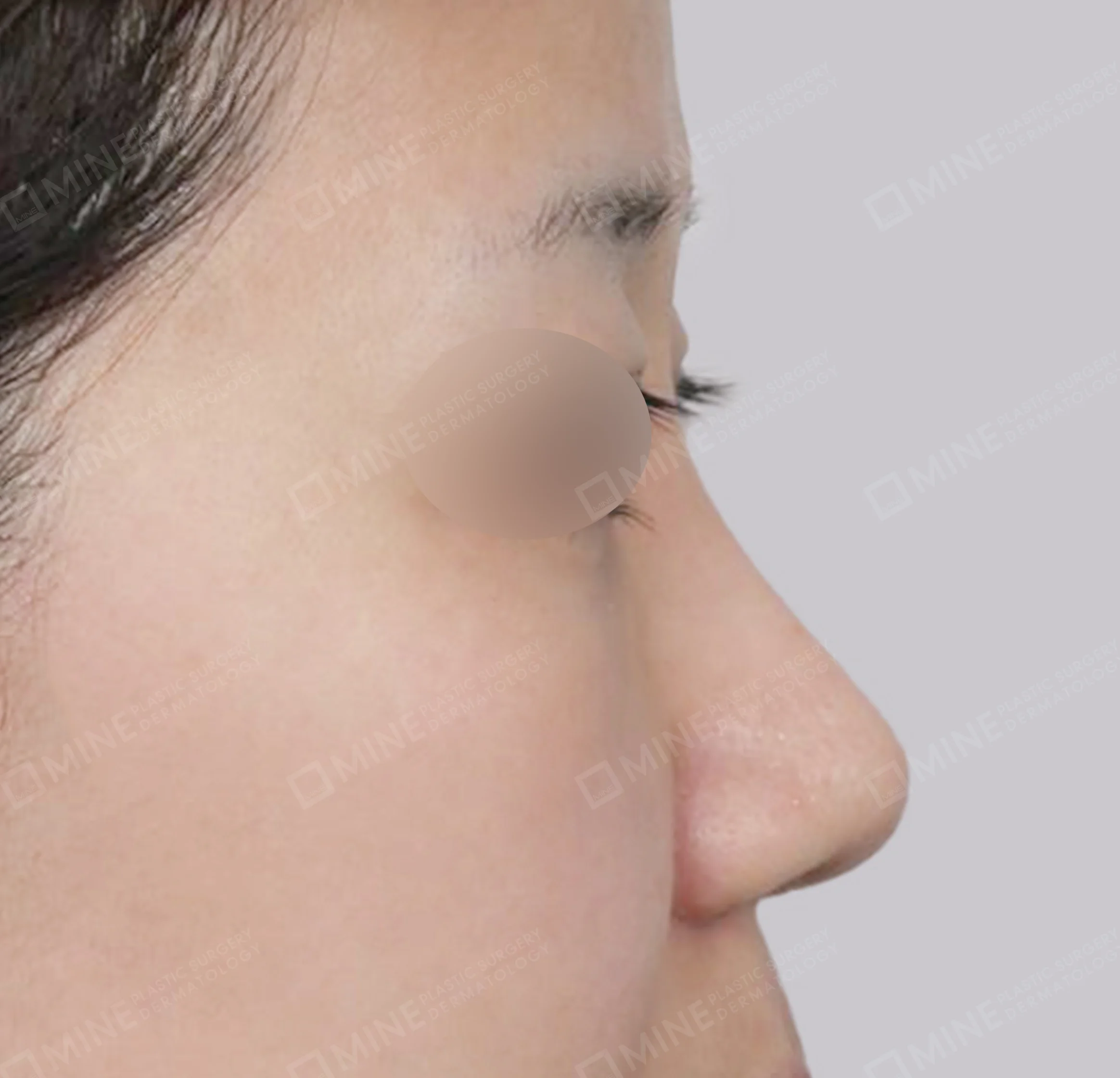 สันจมูก+ลด ปลายจมูก + ลดปีกจมูก + ยาวขึ้น ผนังกั้นช่องจมูก-ด้านข้าง-หลัง