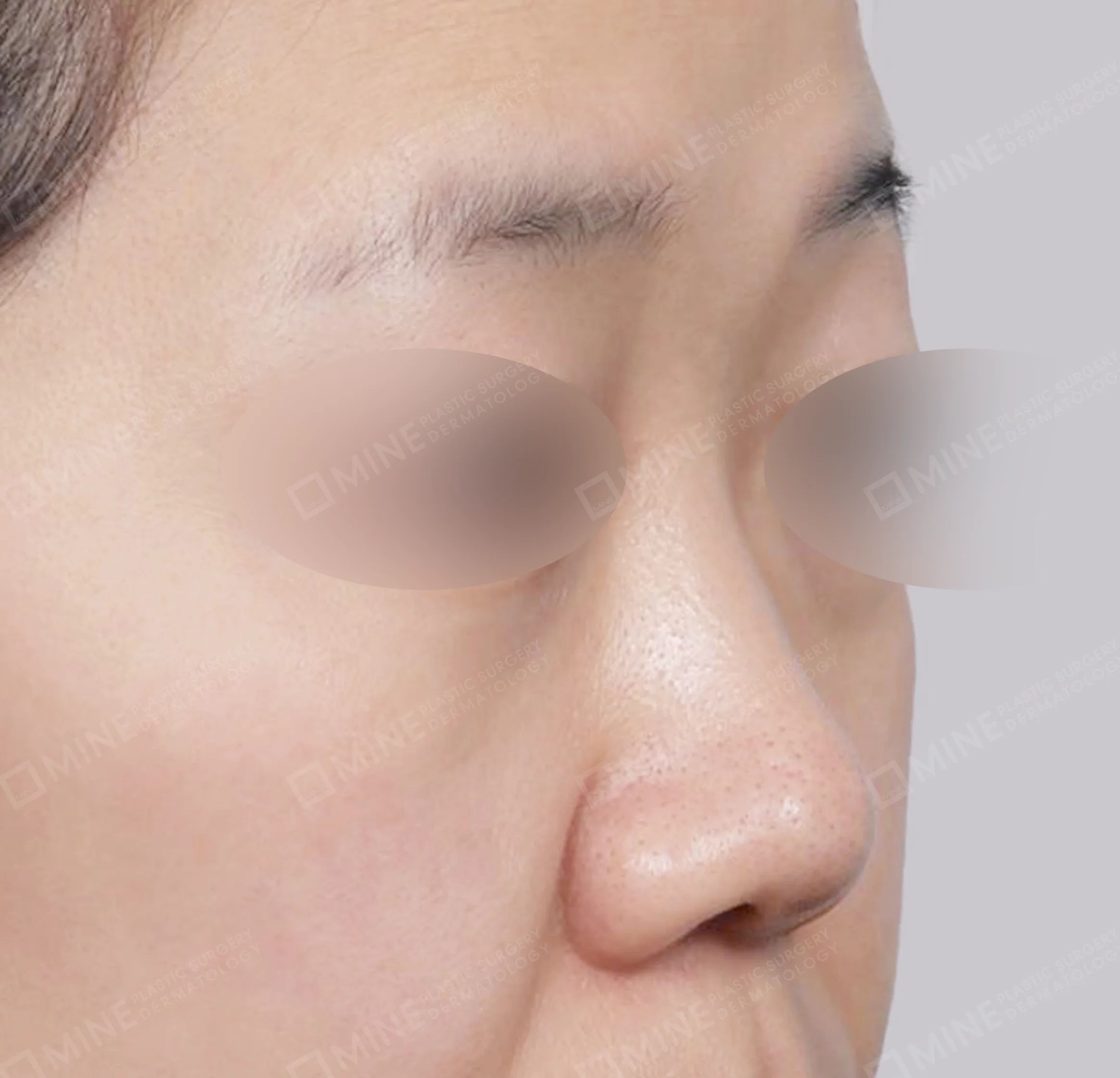 สันจมูก+ลด ปลายจมูก + ลดปีกจมูก + ยาวขึ้น ผนังกั้นช่องจมูก-45 องศา-ก่อน