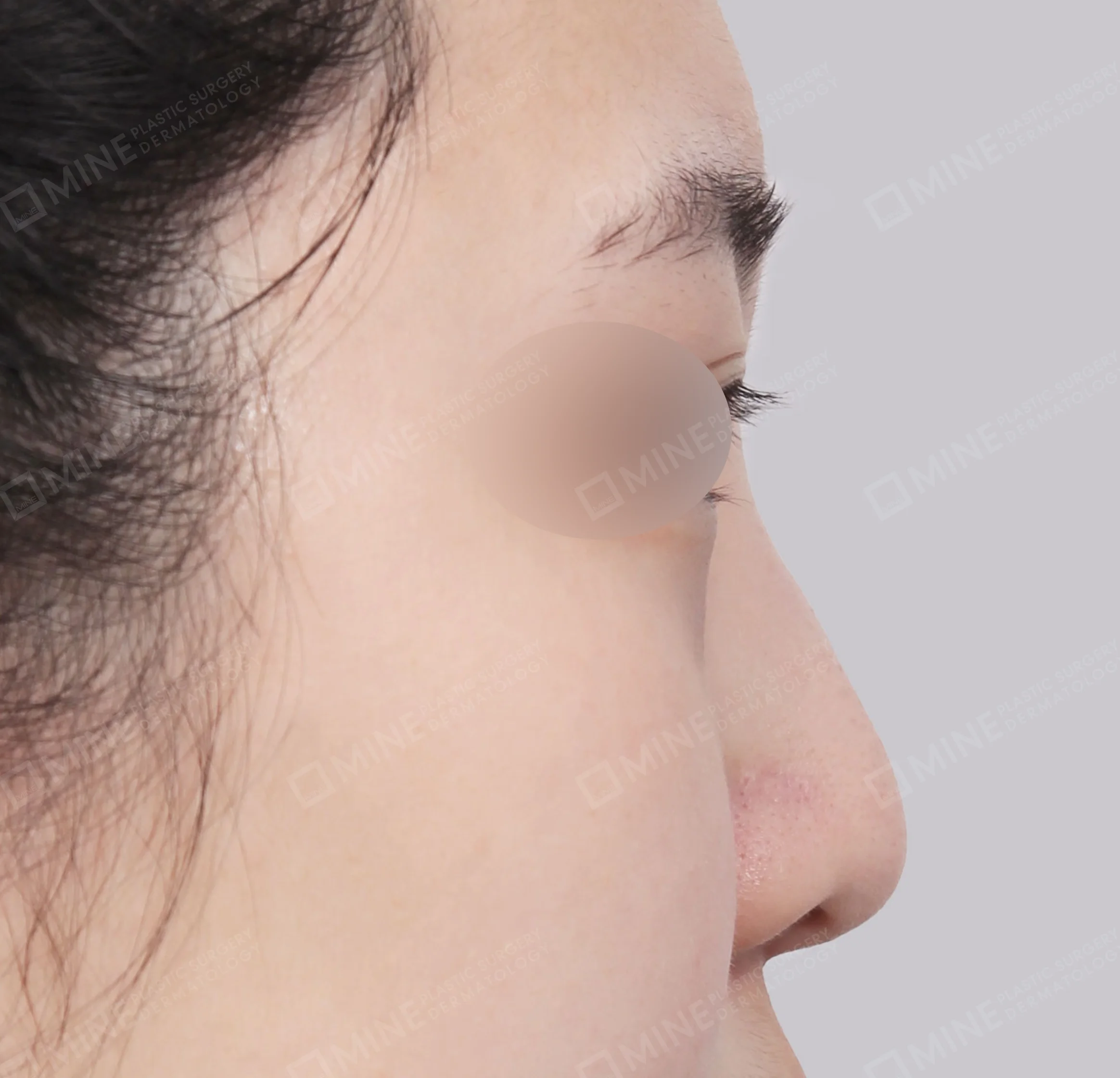 แก้ไขจมูกเบี้ยว + การผ่าตัดกระดูก + ปลายจมูก-45 องศา-ก่อน