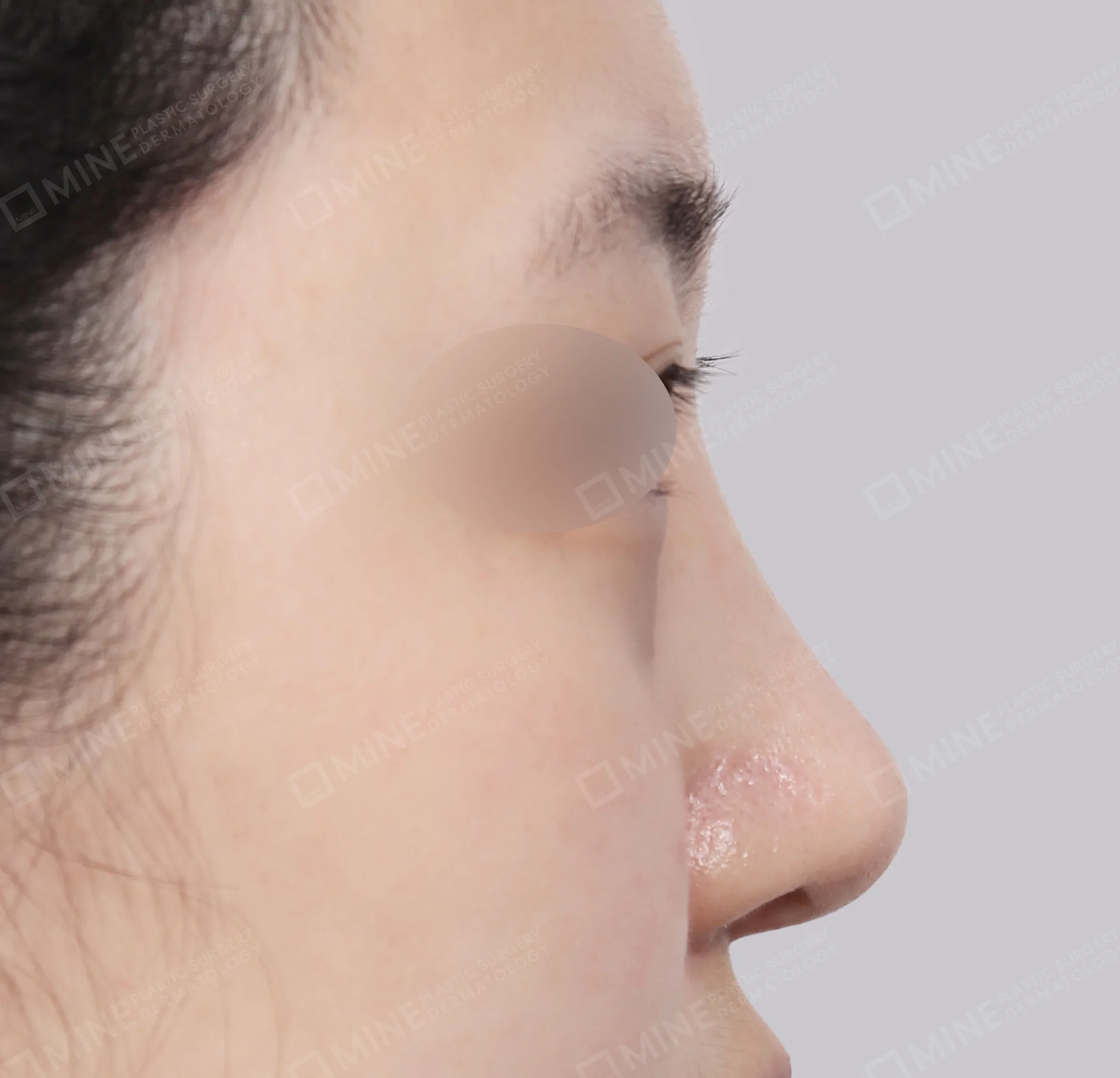 แก้ไขจมูกเบี้ยว + การผ่าตัดกระดูก + ปลายจมูก-45 องศา-หลัง