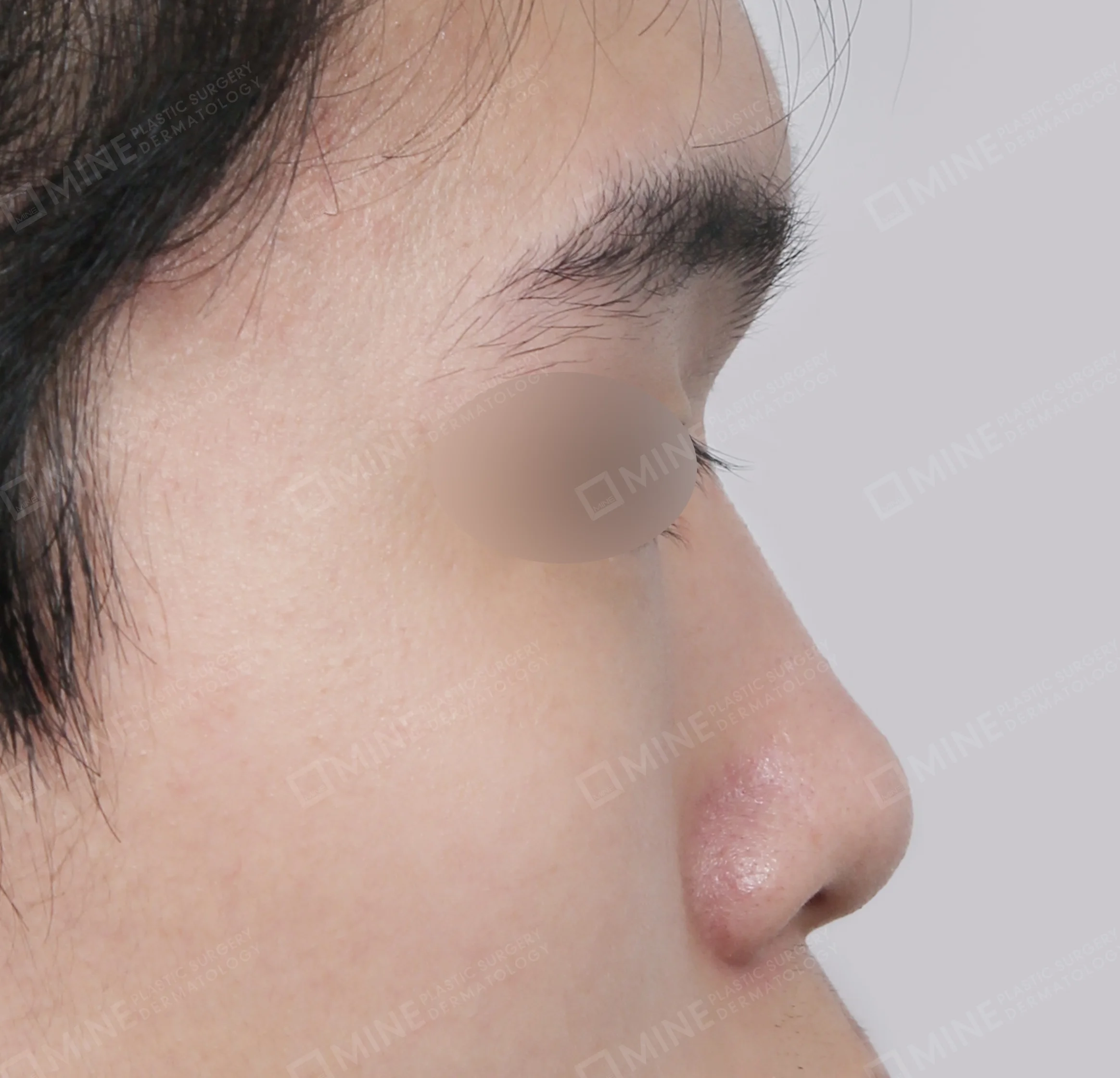 สันจมูก + ปลายจมูก + ยาวขึ้น ผนังกั้นช่องจมูก + ลด ปลายจมูก-ด้านข้าง-ก่อน
