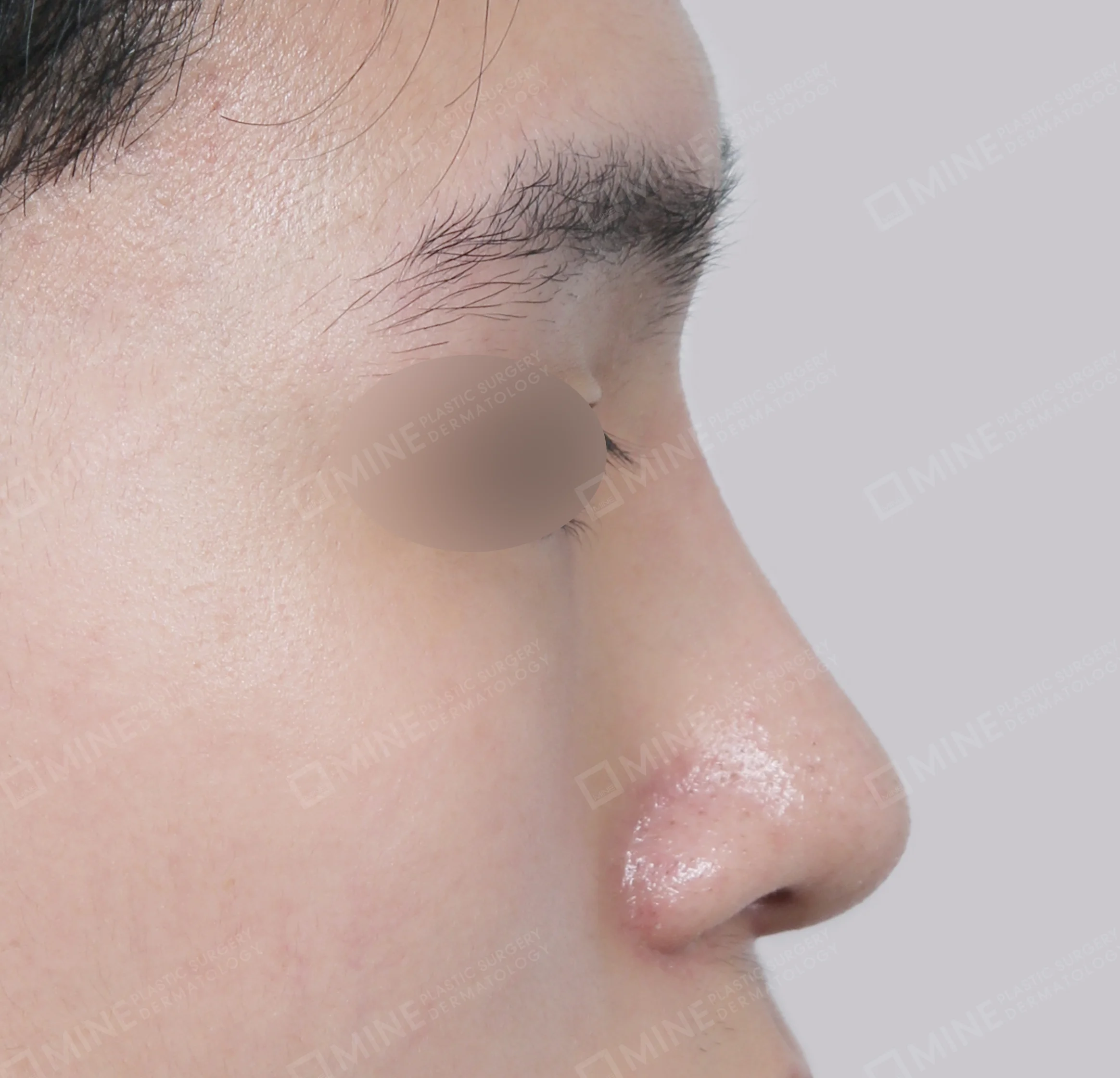 สันจมูก + ปลายจมูก + ยาวขึ้น ผนังกั้นช่องจมูก + ลด ปลายจมูก-ด้านข้าง-หลัง