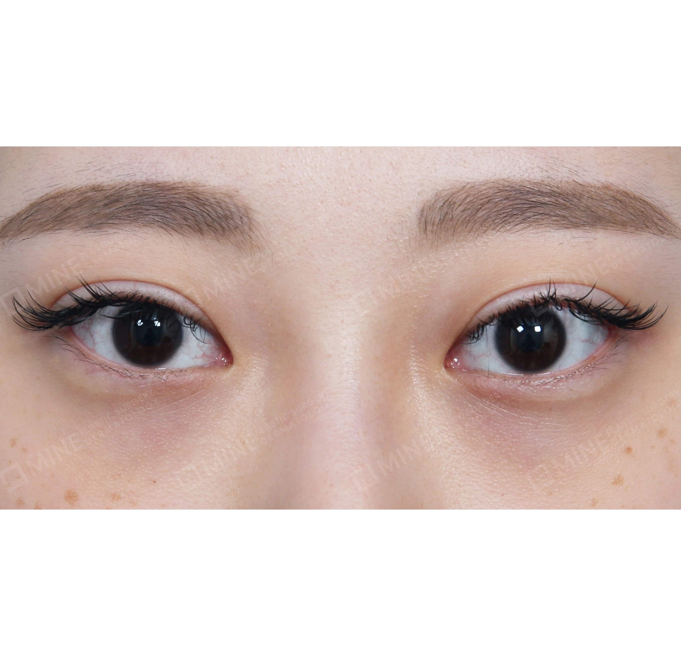 การเปิดหางตา-ด้านหน้า-ก่อน