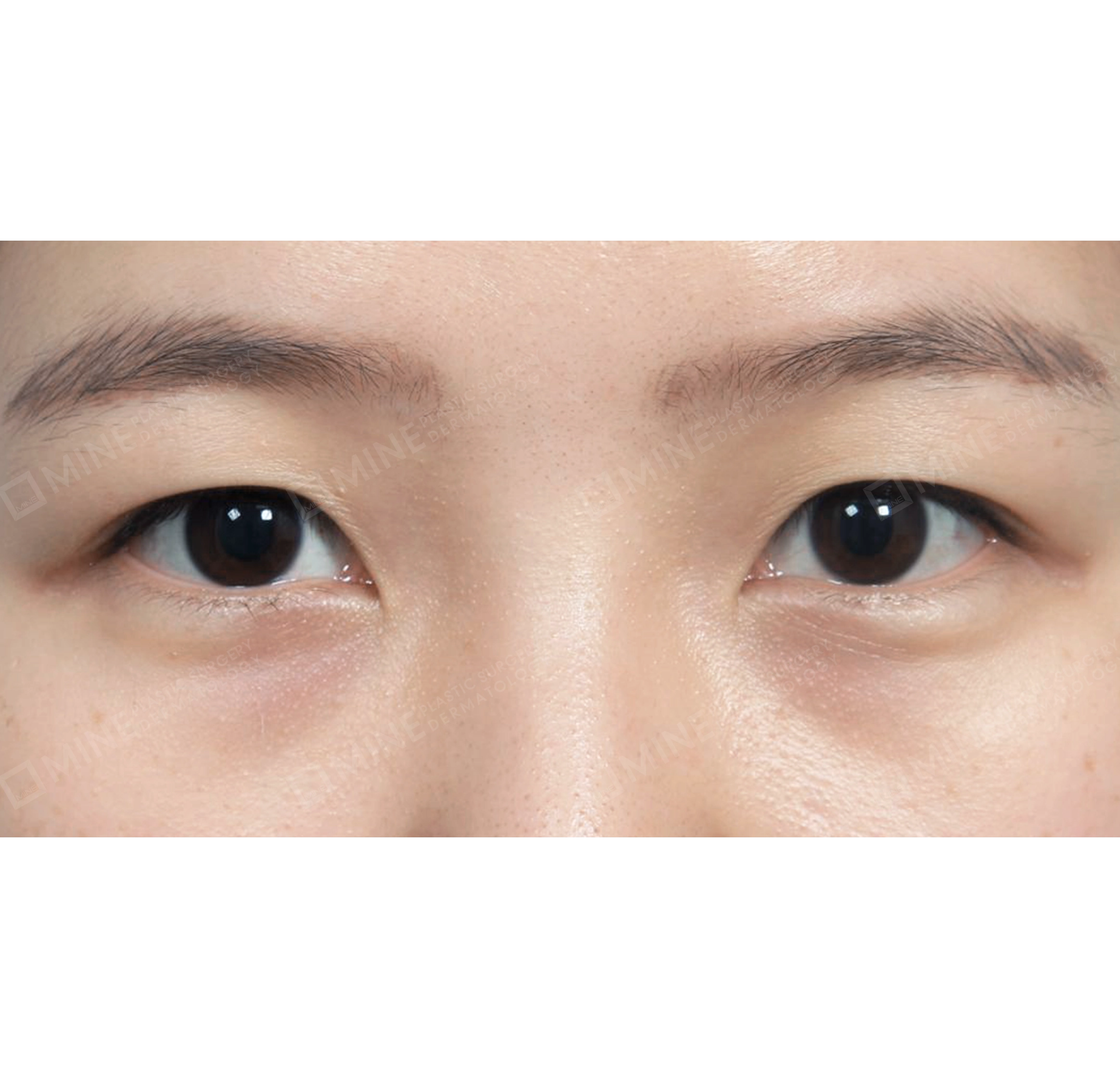 ปรับกล้ามเนื้อตา-ด้านหน้า-ก่อน
