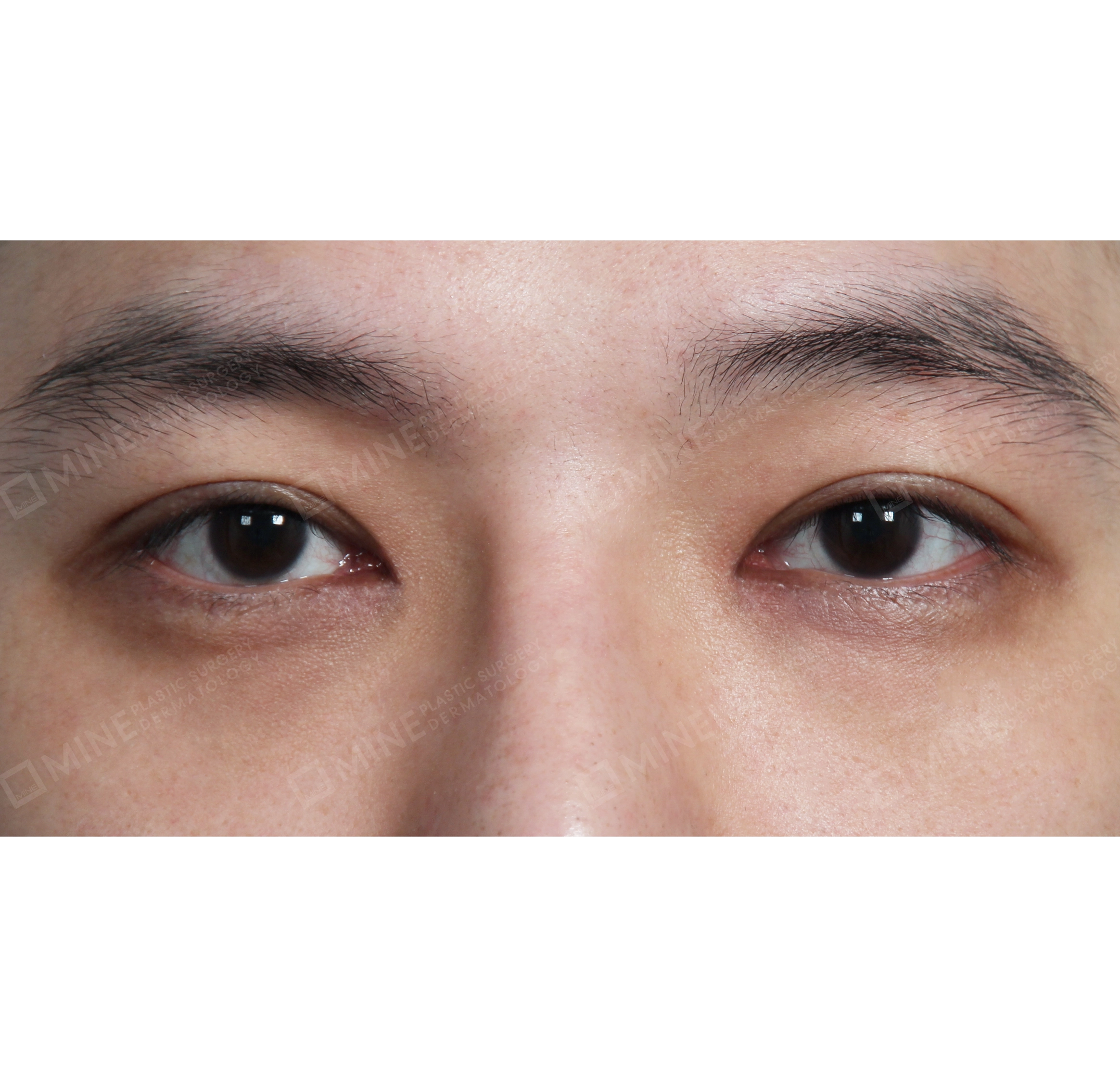 การเย็บแล้วผูกปม + การเปิดหัวตา-ด้านหน้า-หลัง
