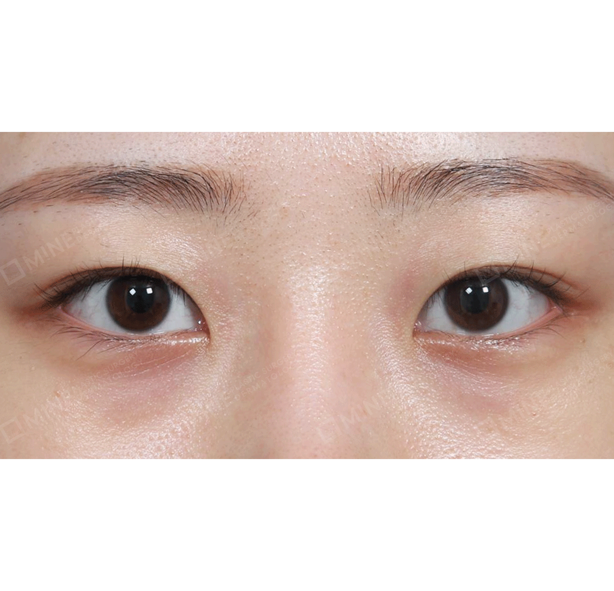 ปรับกล้ามเนื้อตา แบบไม่กรีด + การเปิดหัวตา-ด้านหน้า-ก่อน