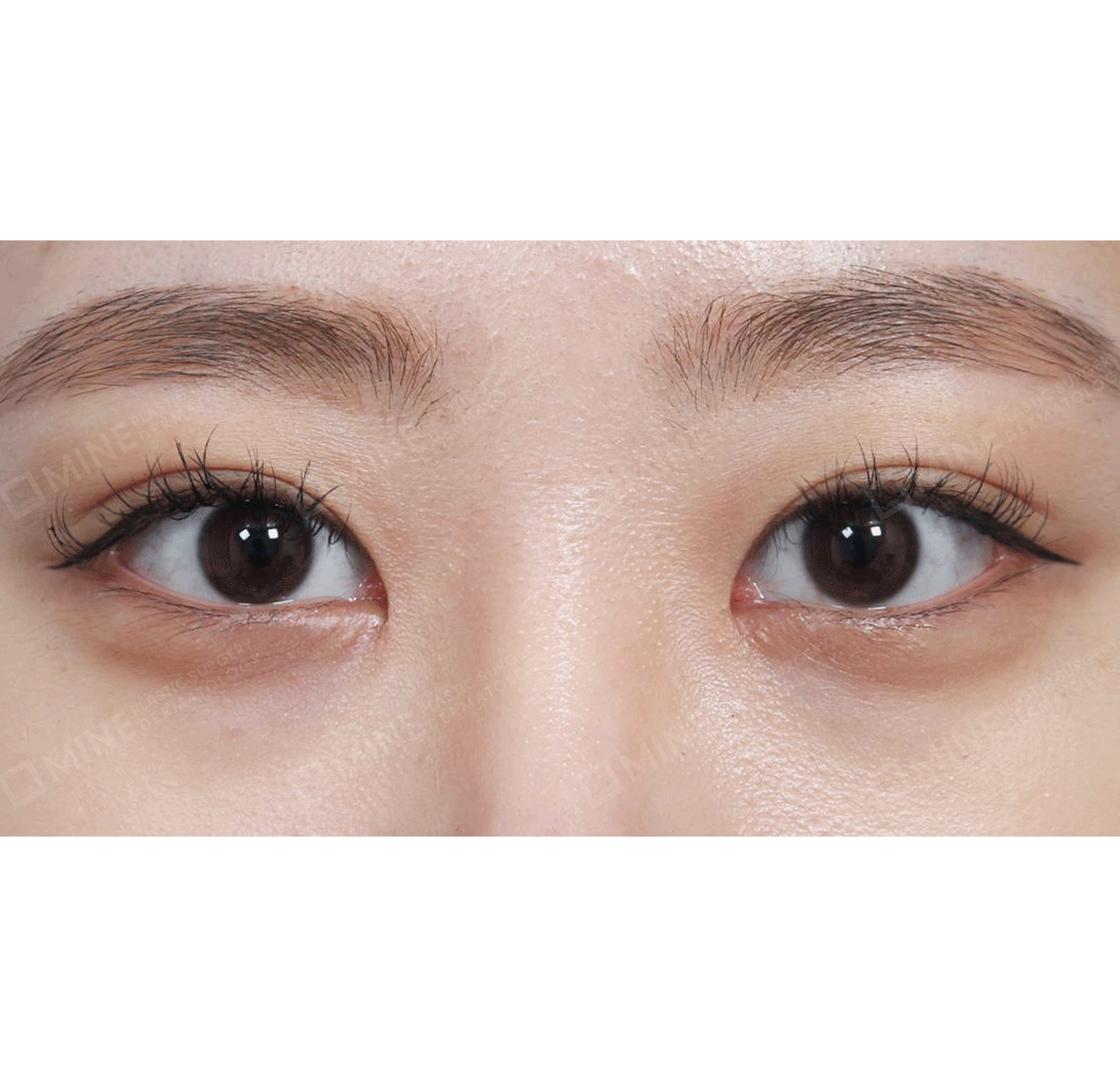ปรับกล้ามเนื้อตา แบบไม่กรีด + การเปิดหัวตา-ด้านหน้า-หลัง