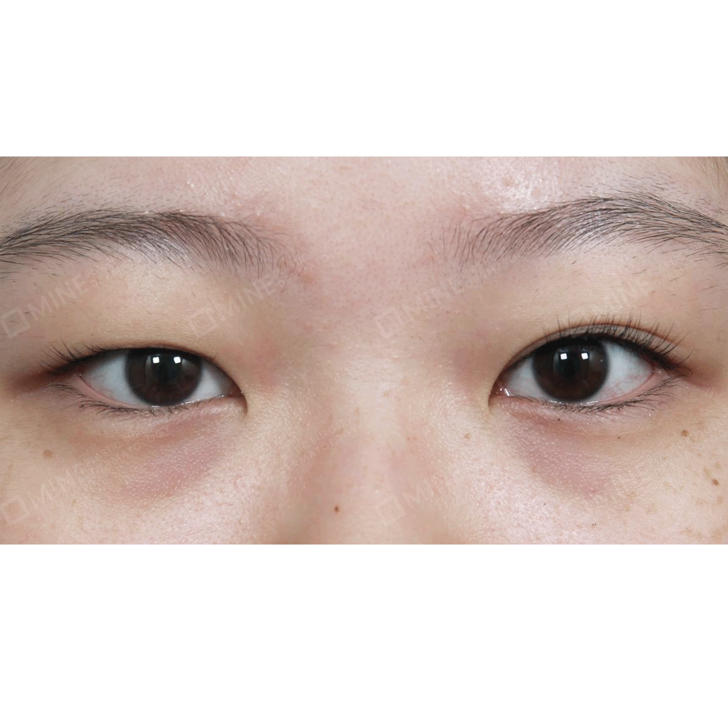 ศัลยกรรมแก้ไข + ปรับกล้ามเนื้อตา การเย็บแล้วผูกปม-ด้านหน้า-ก่อน