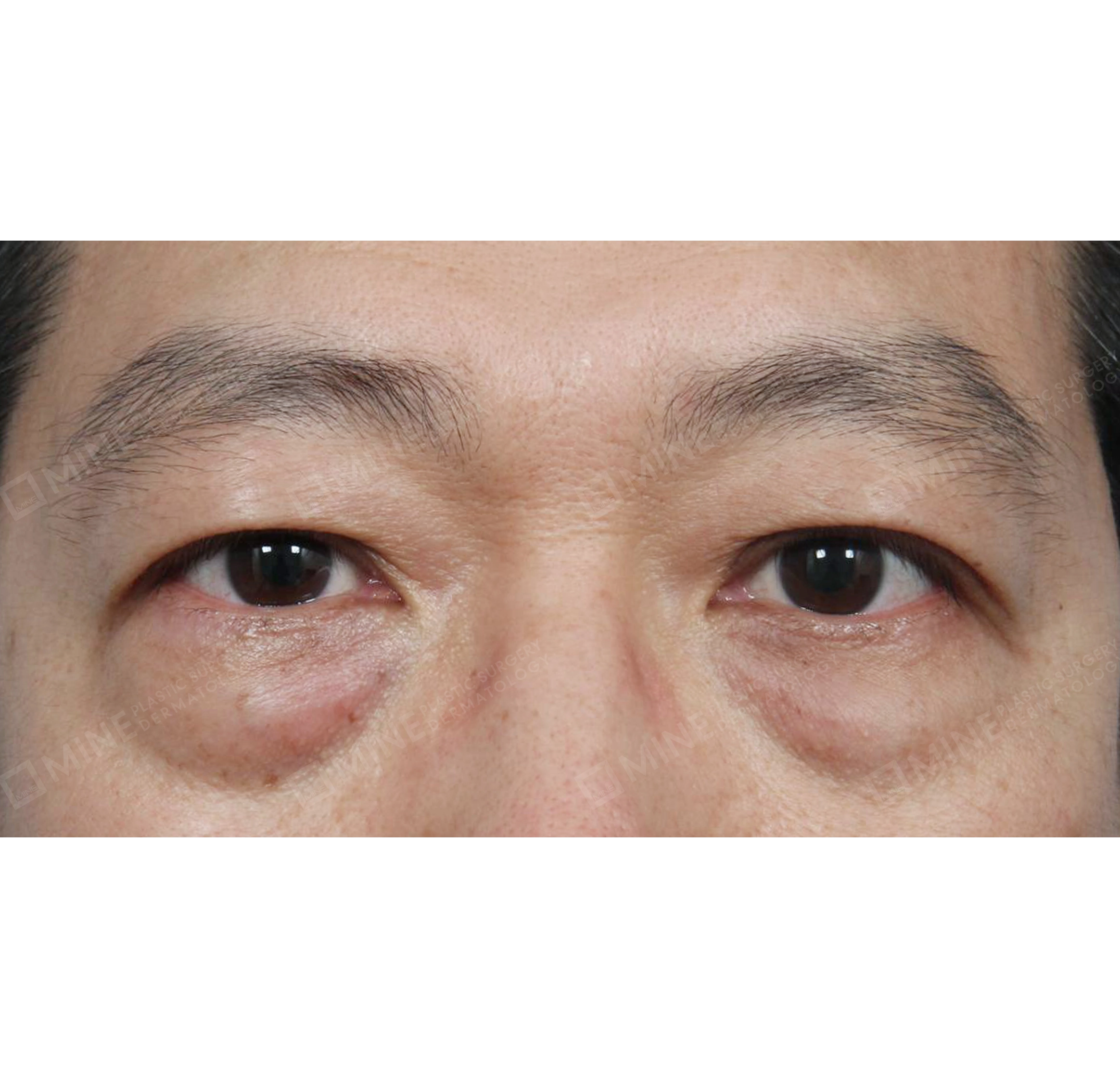 การจัดเรียงไขมันใต้ตา-ด้านหน้า-ก่อน